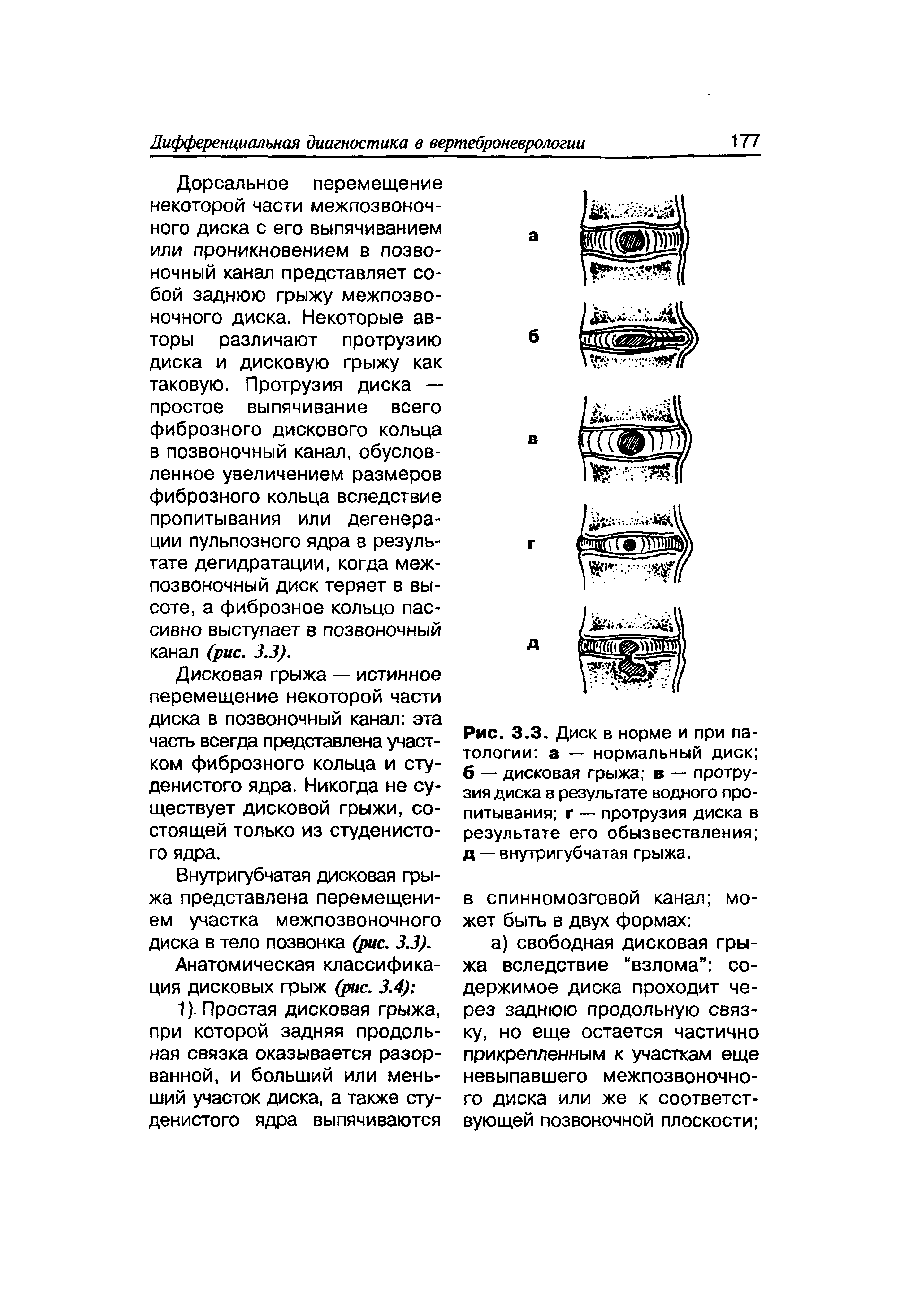 Рис. 3.3. Диск в норме и при патологии а — нормальный диск б — дисковая грыжа в — протрузия диска в результате водного пропитывания г — протрузия диска в результате его обызвествления д — внутригубчатая грыжа.