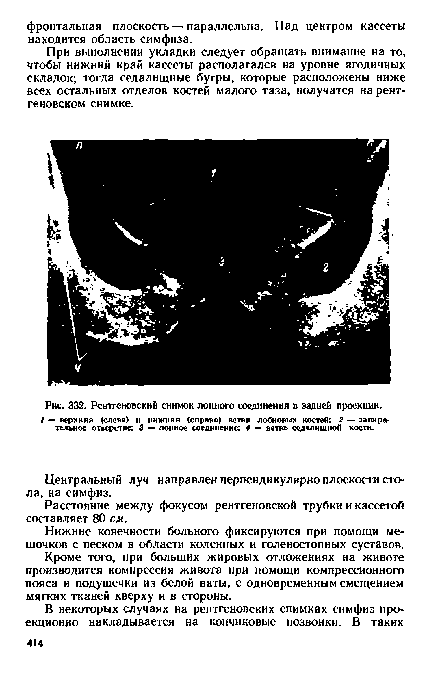 Рис. 332. Рентгеновский снимок лонного соединения в задней проекции.