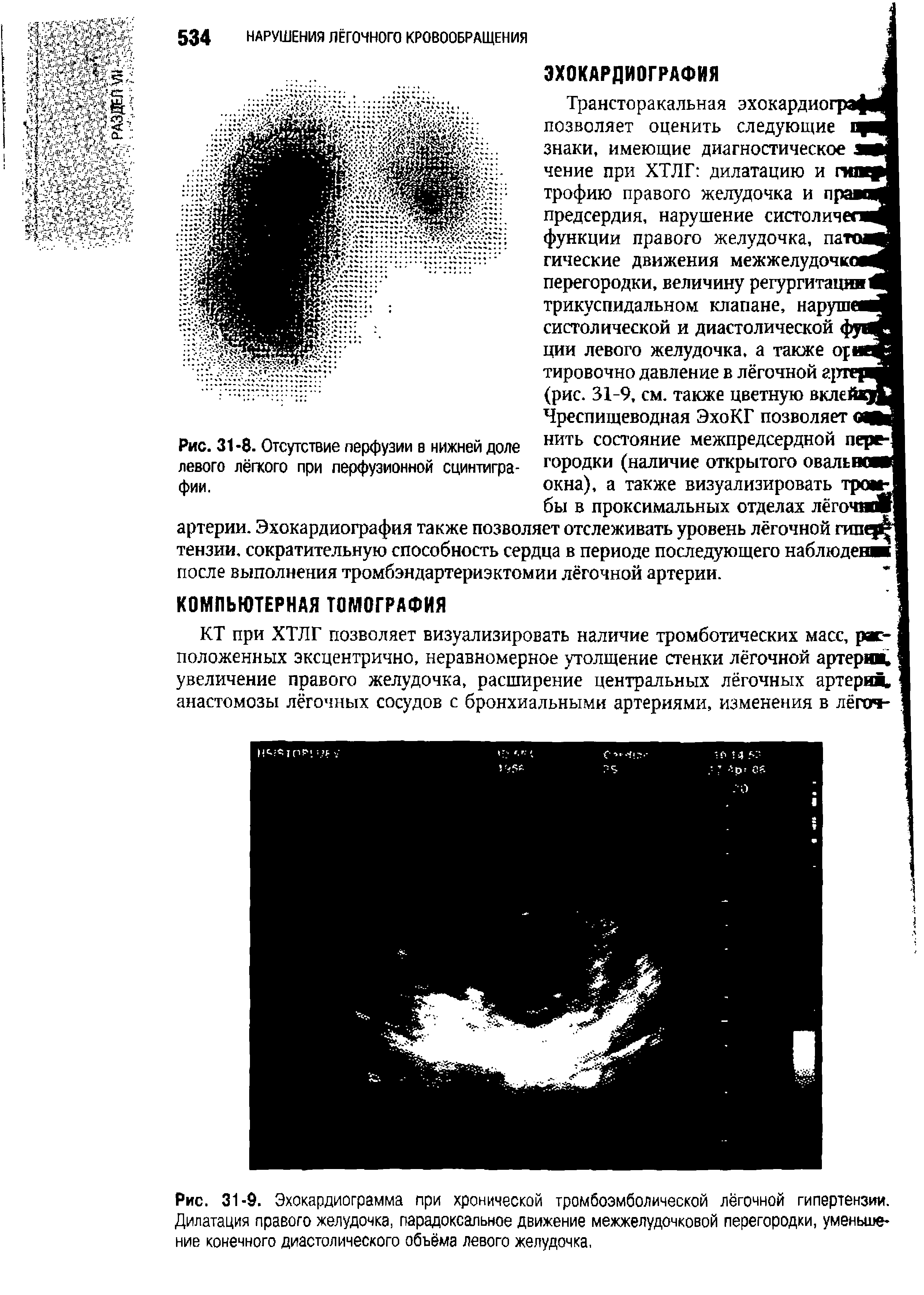 Рис. 31-9. Эхокардиограмма при хронической тромбоэмболической легочной гипертензии. Дилатация правого желудочка, парадоксальное движение межжелудочковой перегородки, уменьшение конечного диастолического объёма левого желудочка,...