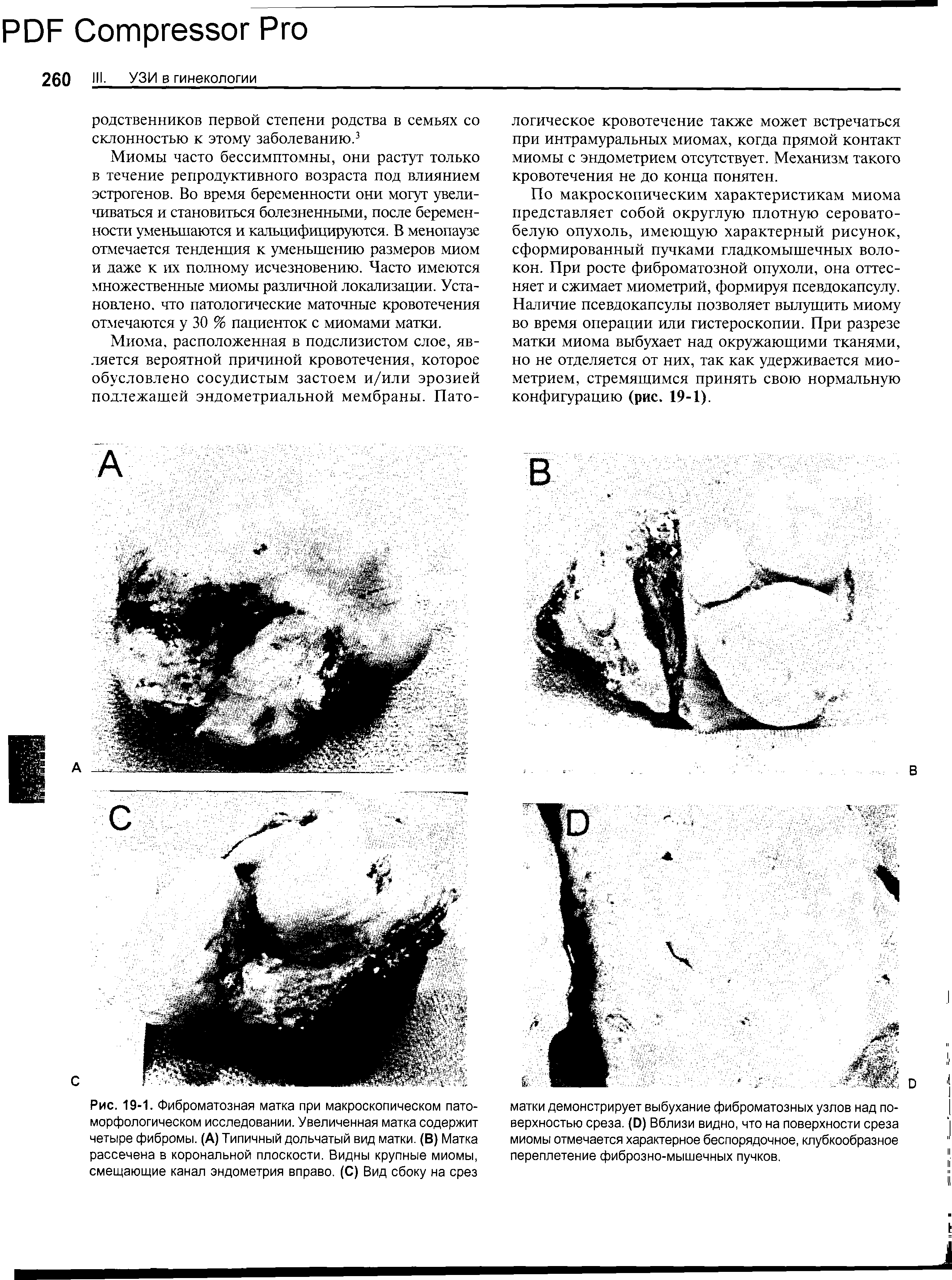 Рис. 19-1. Фиброматозная матка при макроскопическом пато-морфологическом исследовании. Увеличенная матка содержит четыре фибромы. (А) Типичный дольчатый вид матки. (В) Матка рассечена в корональной плоскости. Видны крупные миомы, смещающие канал эндометрия вправо. (С) Вид сбоку на срез...