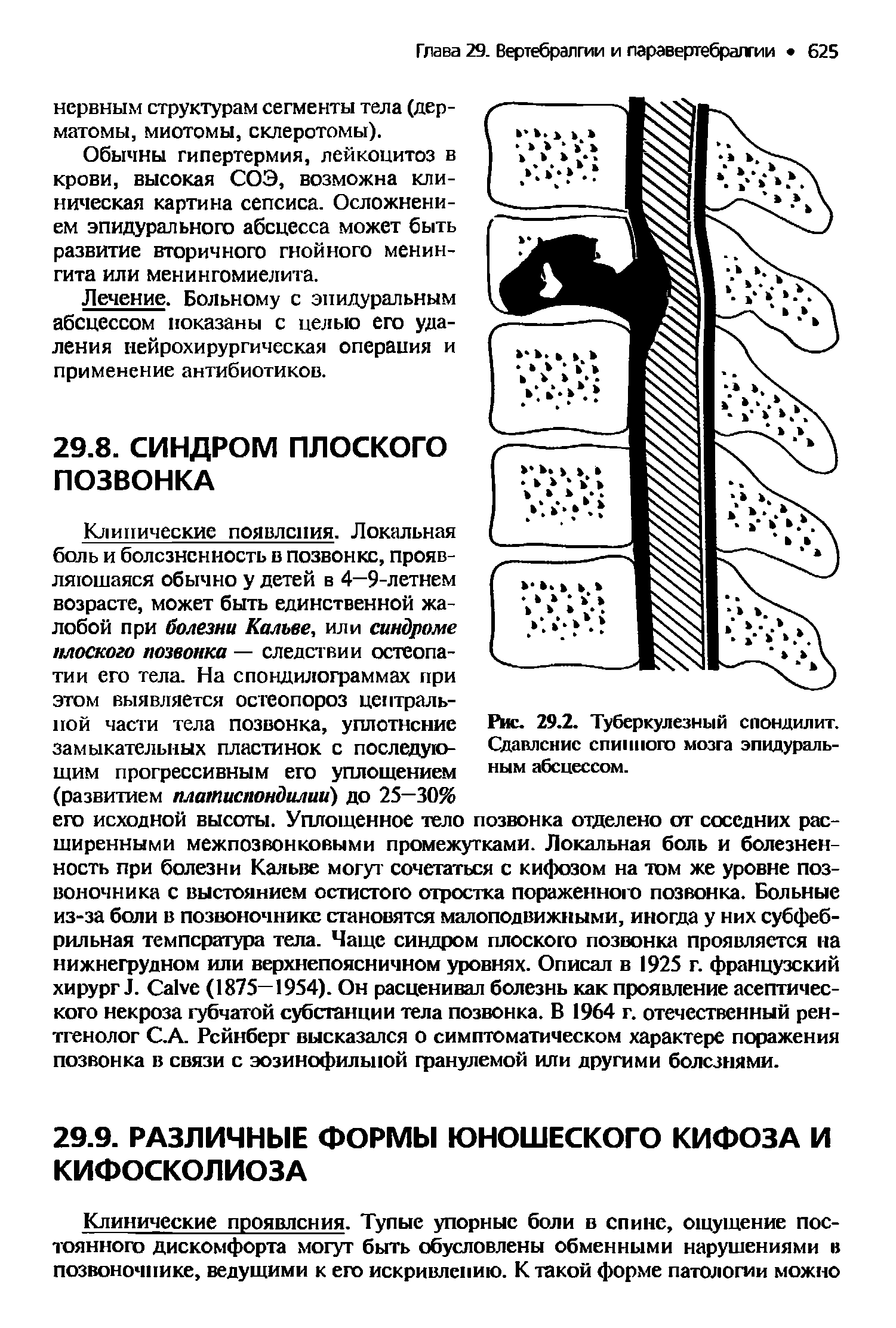 Рис. 29.2. Туберкулезный спондилит. Сдавление спинного мозга эпидуральным абсцессом.