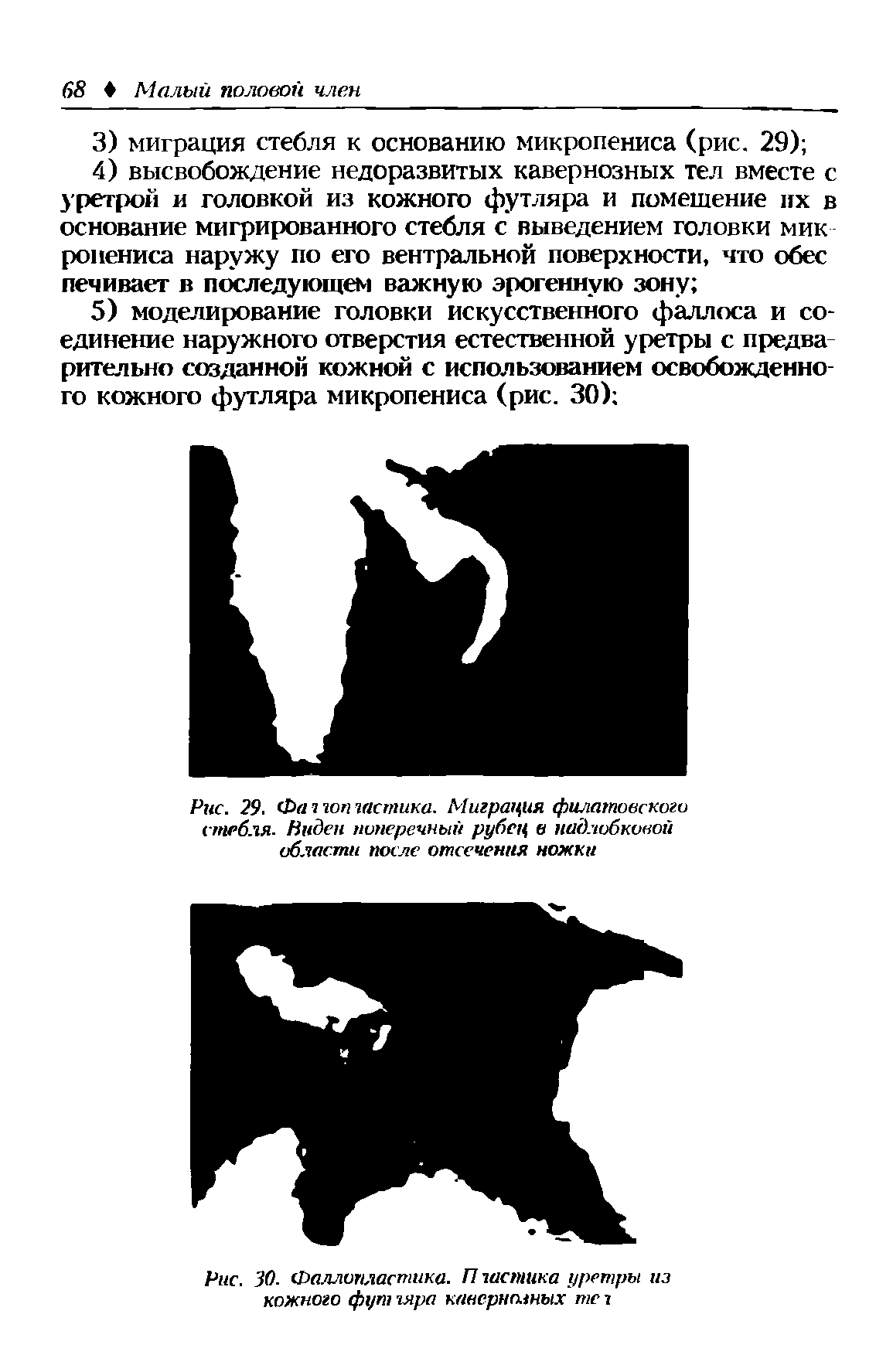 Рис. 30. Фаллопластика. П частика уретры из кожного фут гяра каиернмных те 7...