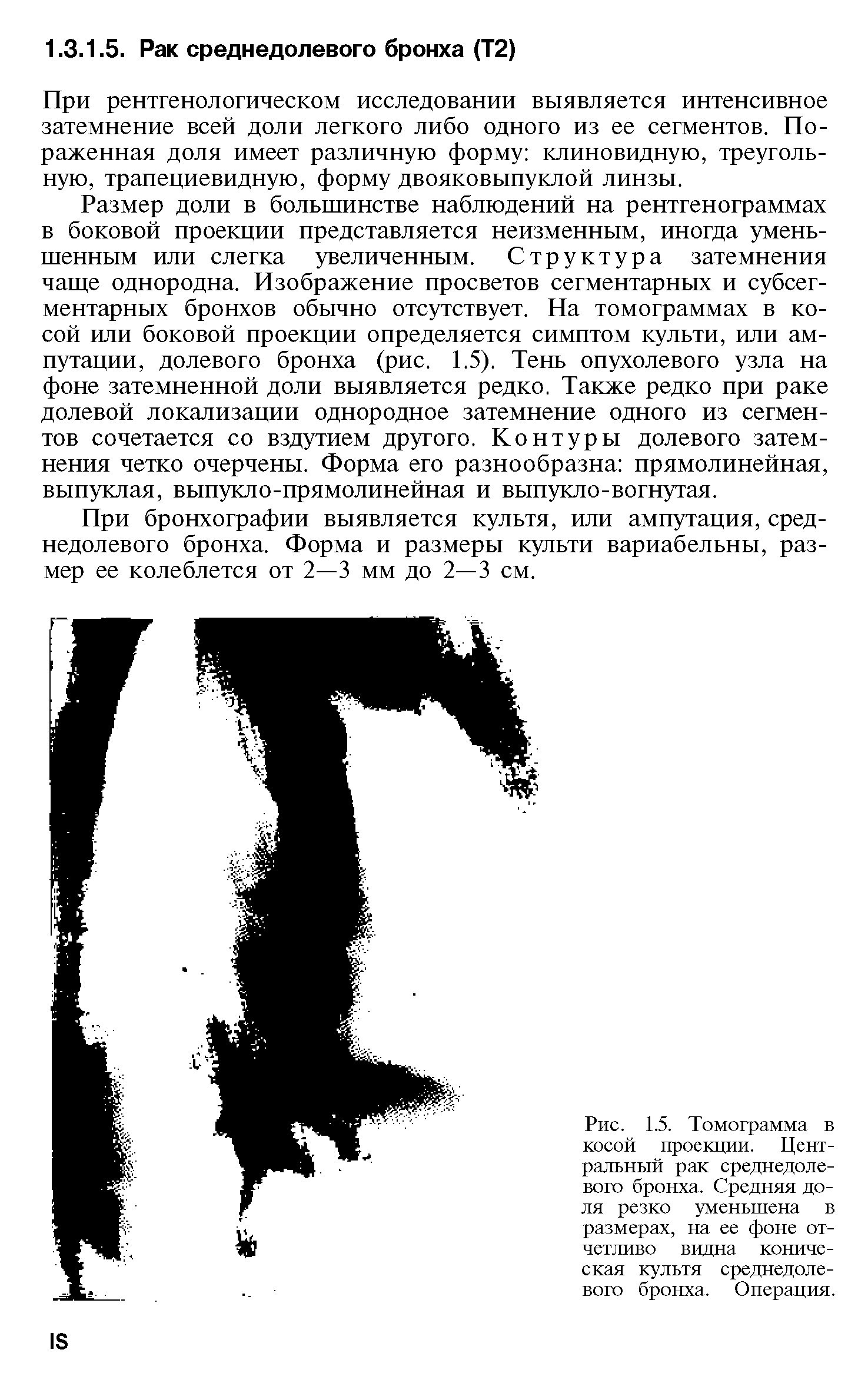 Рис. 1.5. Томограмма в косой проекции. Центральный рак среднедолевого бронха. Средняя доля резко уменьшена в размерах, на ее фоне отчетливо видна коническая культя среднедолевого бронха. Операция.