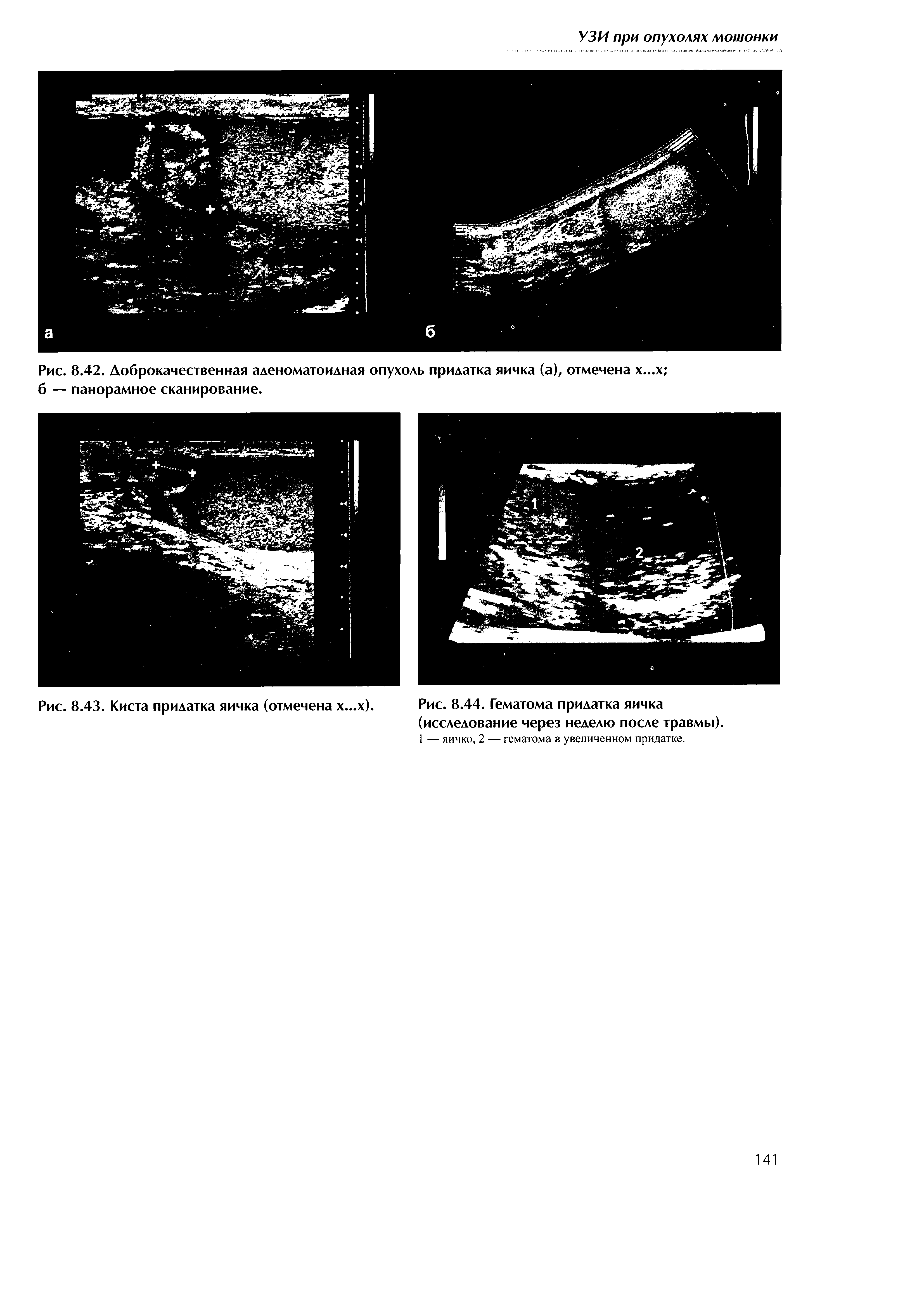 Рис. 8.43. Киста придатка яичка (отмечена х...х). Рис. 8.44. Гематома придатка яичка (исследование через неделю после травмы).