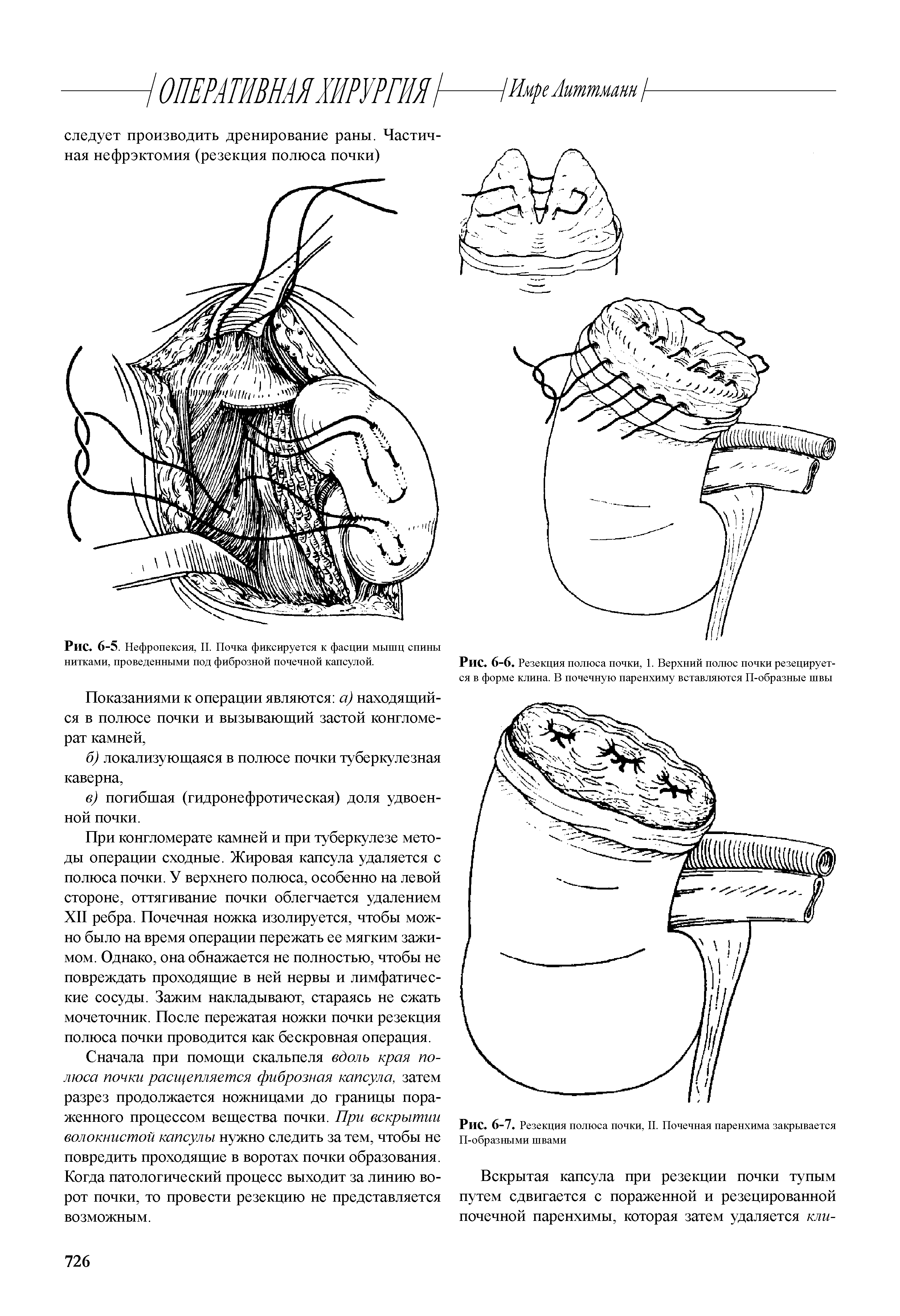 Рис. 6-7. Резекция полюса почки, II. Почечная паренхима закрывается П-образными швами...