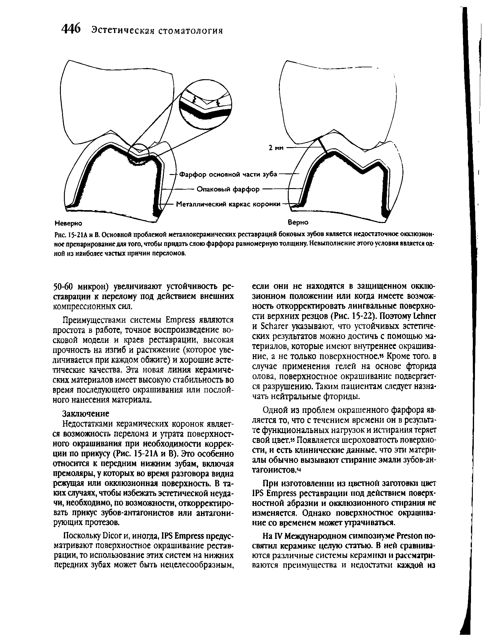 Рис. 15-21Аи В. Основной проблемой металлокерамических реставраций боковых зубов является недостаточное окклюзионное препарирование для того, чтобы придать слою фарфора равномерную толщину. Невыполнение этого условия является одной из наиболее частых причин переломов.