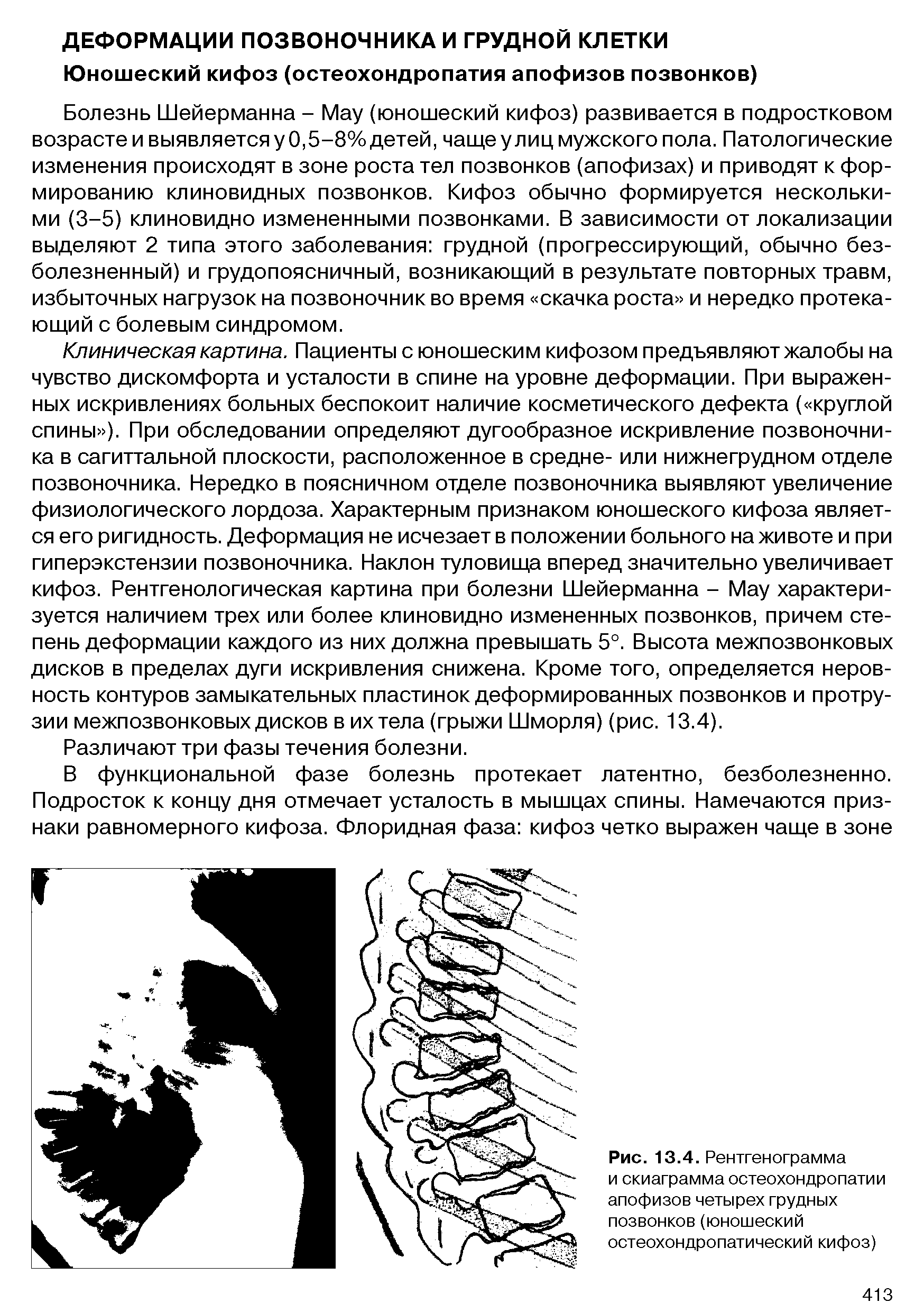 Рис. 13.4. Рентгенограмма и скиаграмма остеохондропатии апофизов четырех грудных позвонков (юношеский остеохондропатический кифоз)...