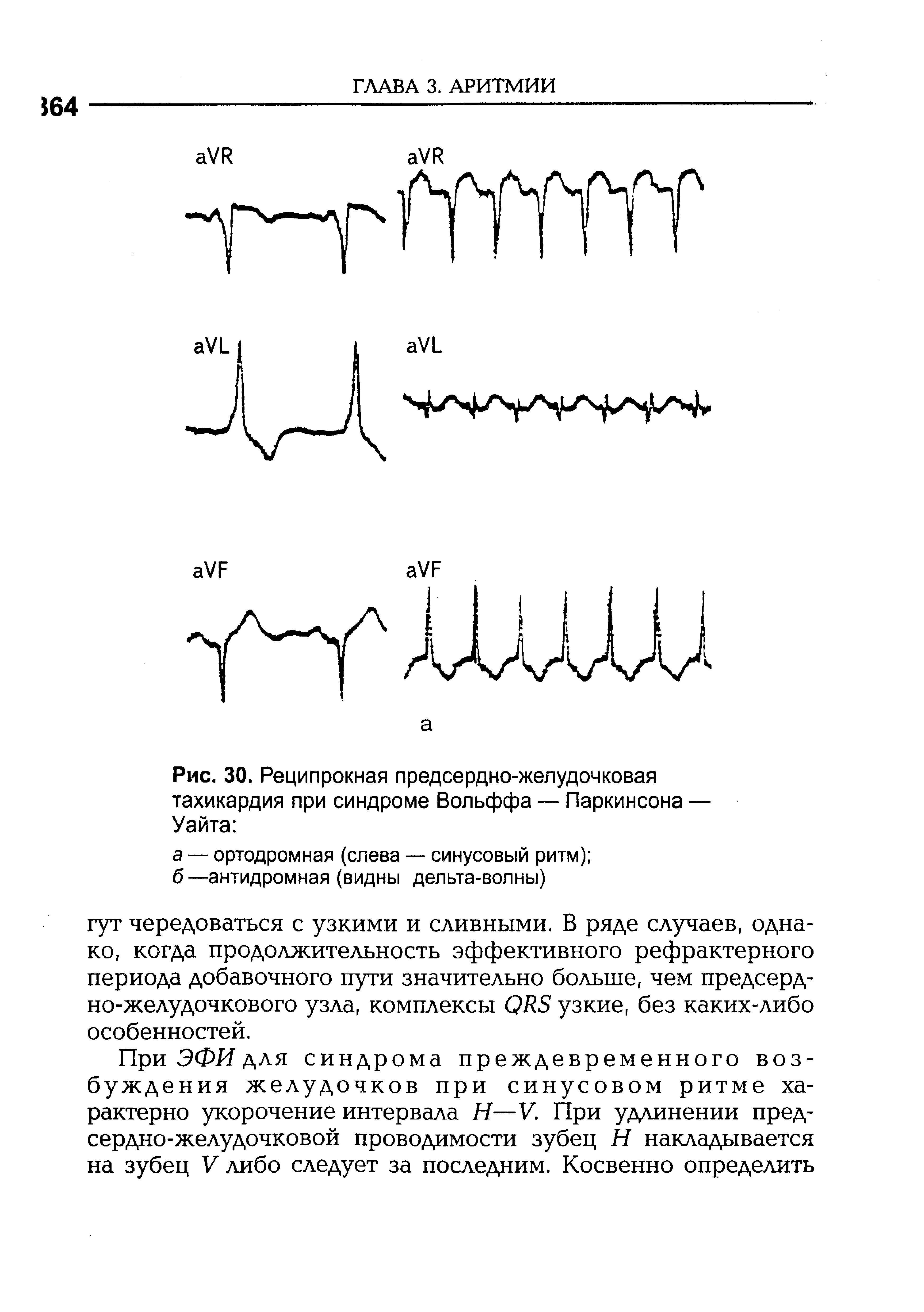 Рис. 30. Реципрокная предсердно-желудочковая тахикардия при синдроме Вольффа — Паркинсона — Уайта ...