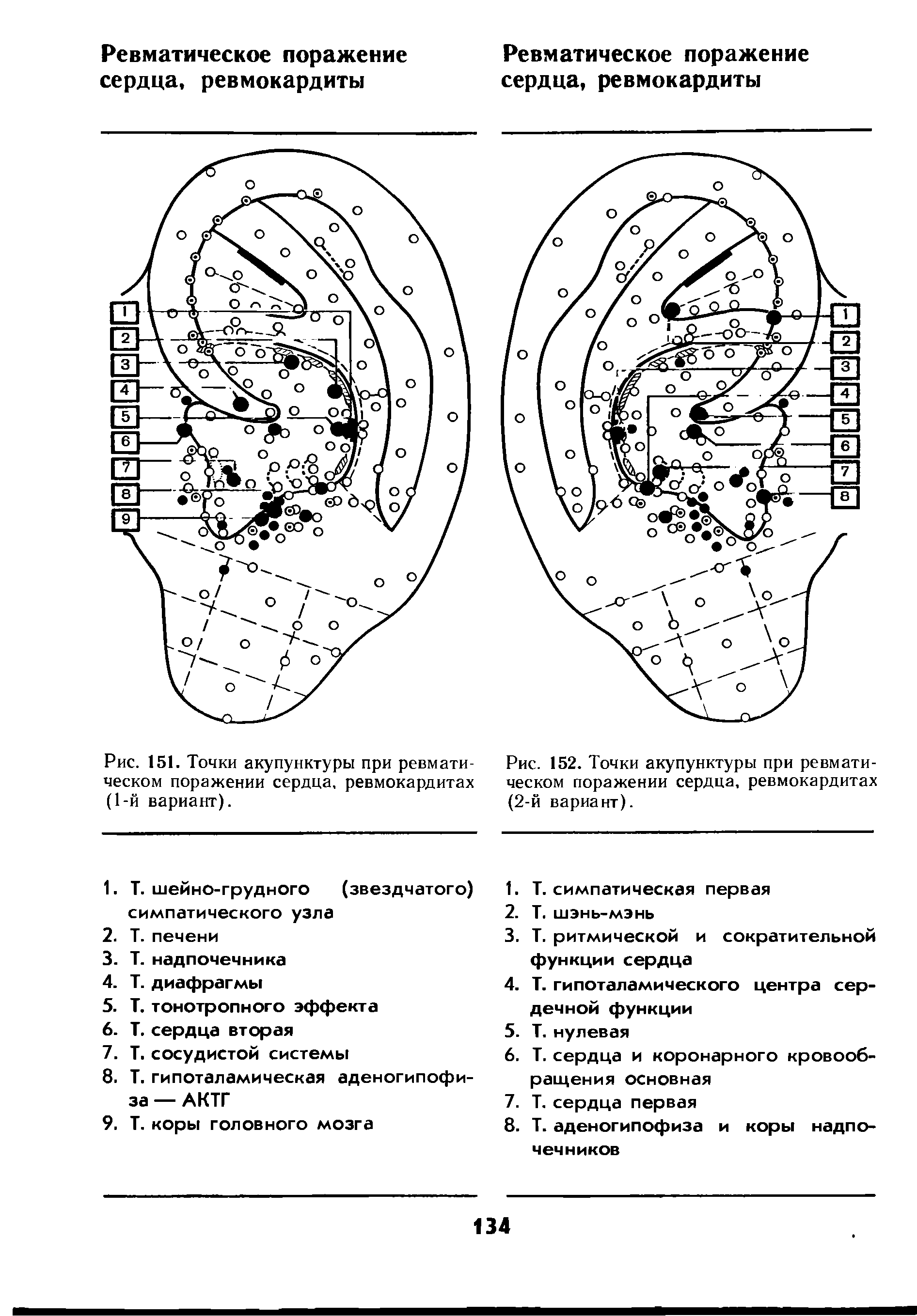 Рис. 151. Точки акупунктуры при ревматическом поражении сердца, ревмокардитах (1-й вариант).