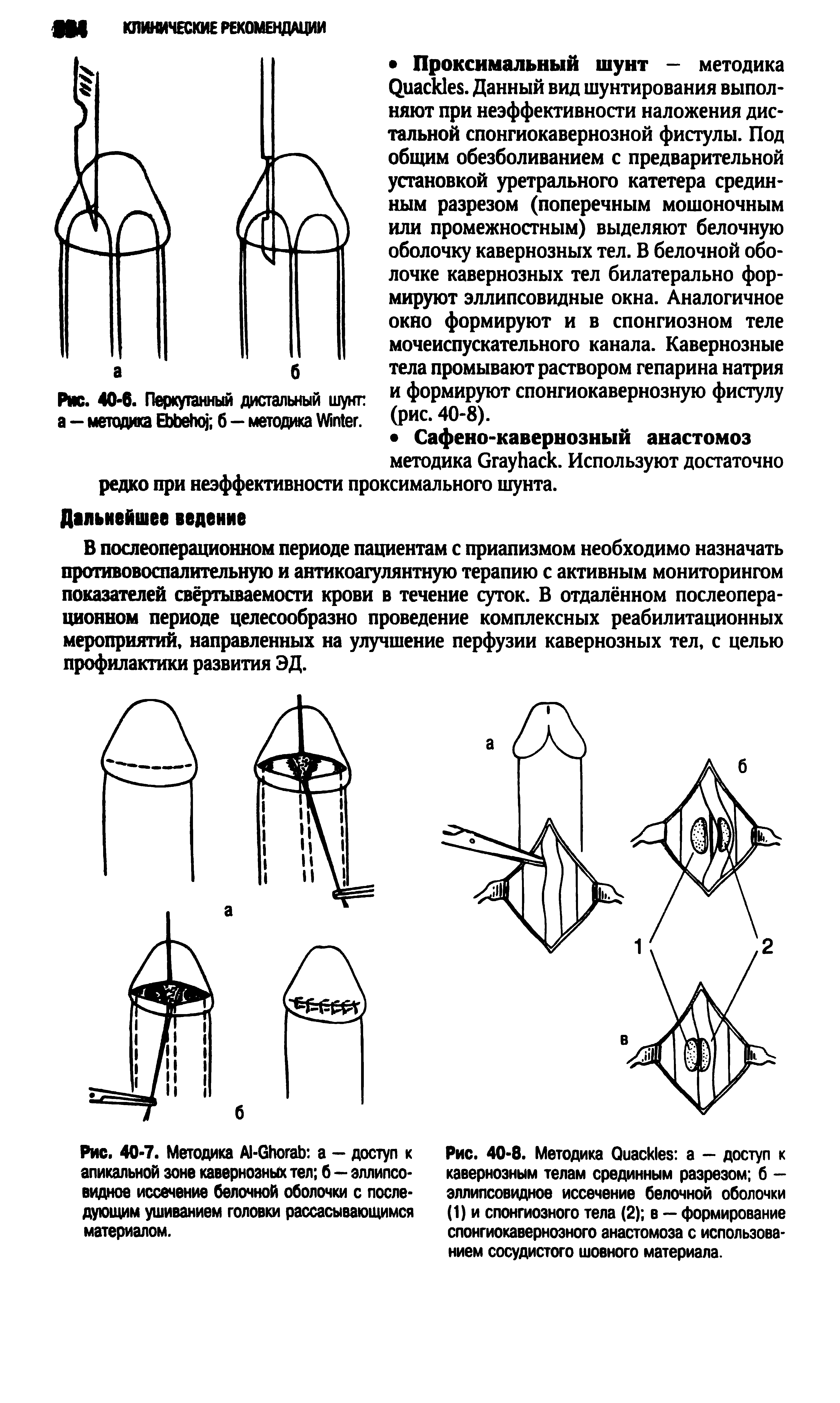 Рис. 40-7. Методика А1-61югаЬ а — доступ к апикальной зоне кавернозных тел б—эллипсовидное иссечение белочной оболочки с последующим ушиванием головки рассасывающимся материалом.