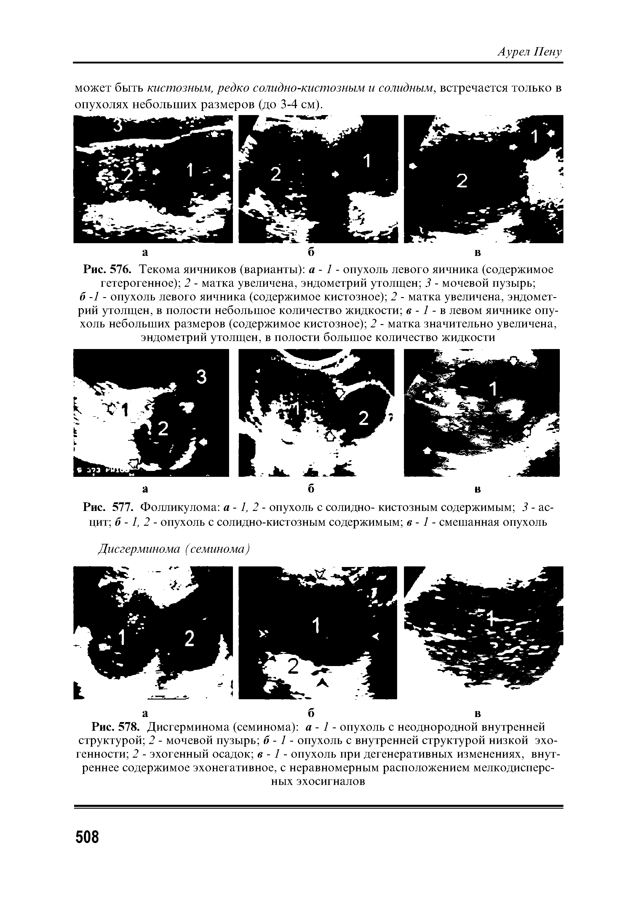 Рис. 577. Фолликулома а -1, 2 - опухоль с солидно- кистозным содержимым 3 - асцит б -1, 2 - опухоль с солидно-кистозным содержимым в -1 - смешанная опухоль...