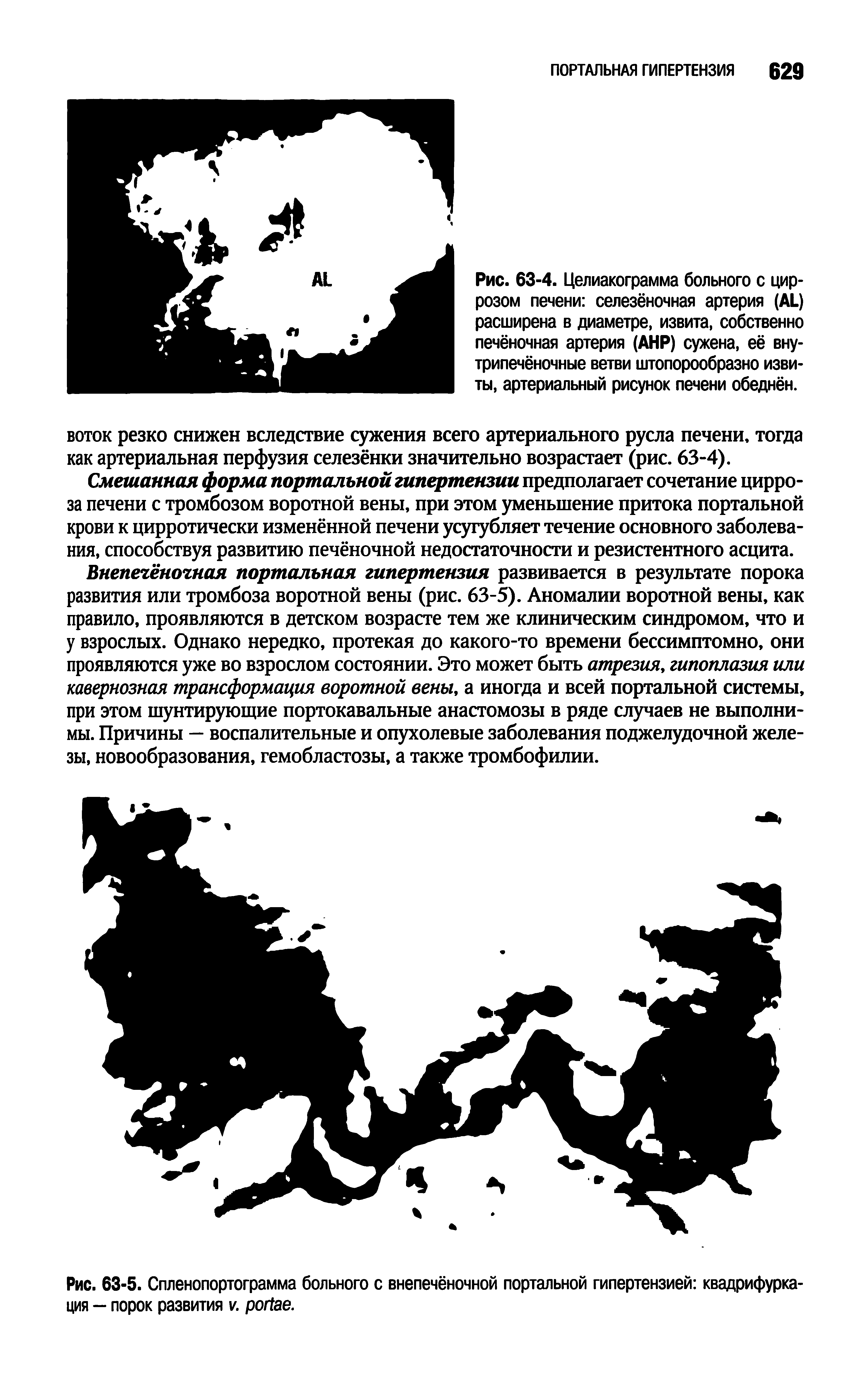 Рис. 63-5. Спленопортограмма больного с внепечёночной портальной гипертензией квадрифурка-ция — порок развития . .