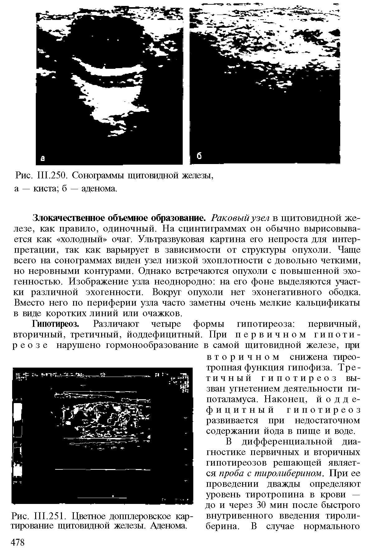 Рис. III.251. Цветное допплеровское картирование щитовидной железы. Аденома.