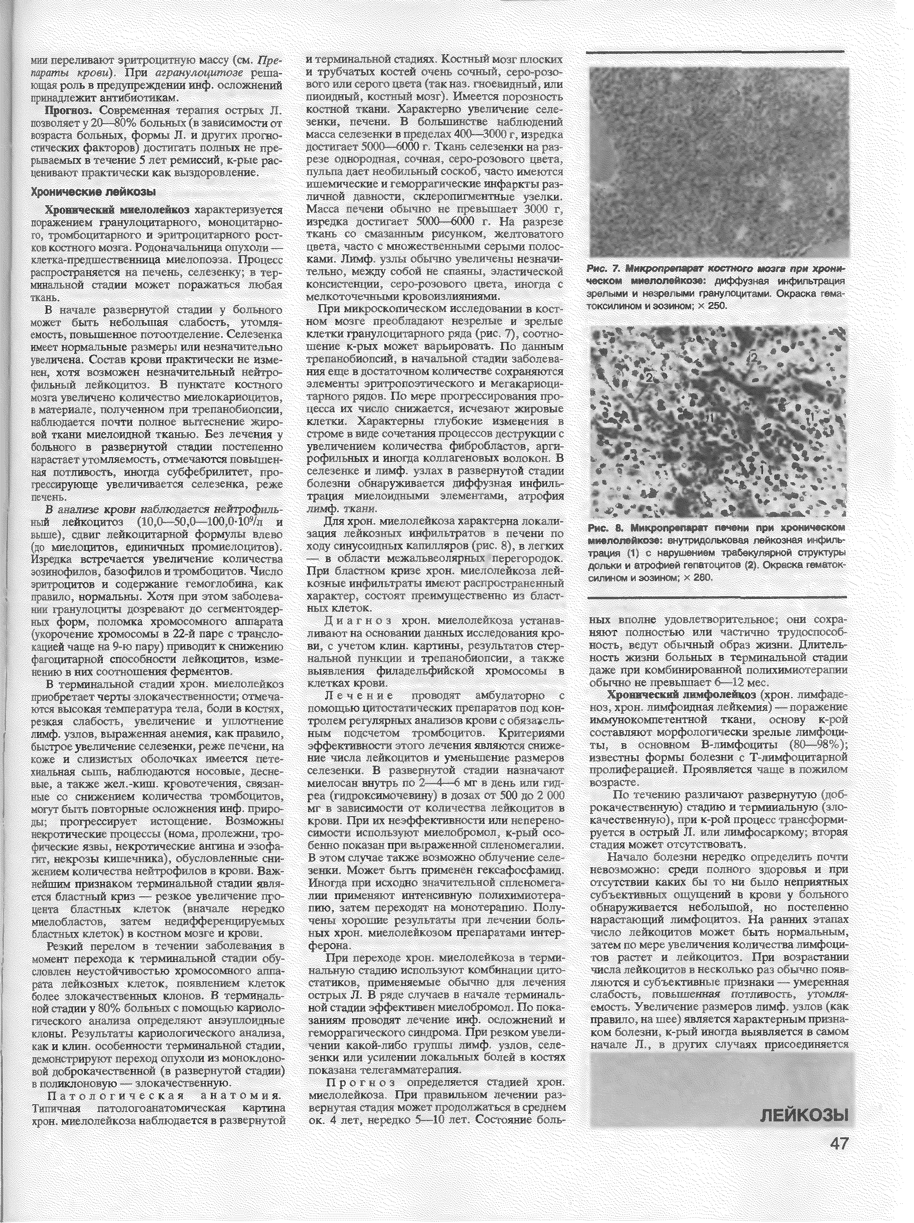 Рис.. 8. Микропрвпаржт печени при хроническом миелолейкозе внутридольковая лейкозная инфильтрация И < нарушением трабекулярной структуры дольки и атрофией г а,. .да ->в 2 Окошка < л- л сплином и эозином х 280.