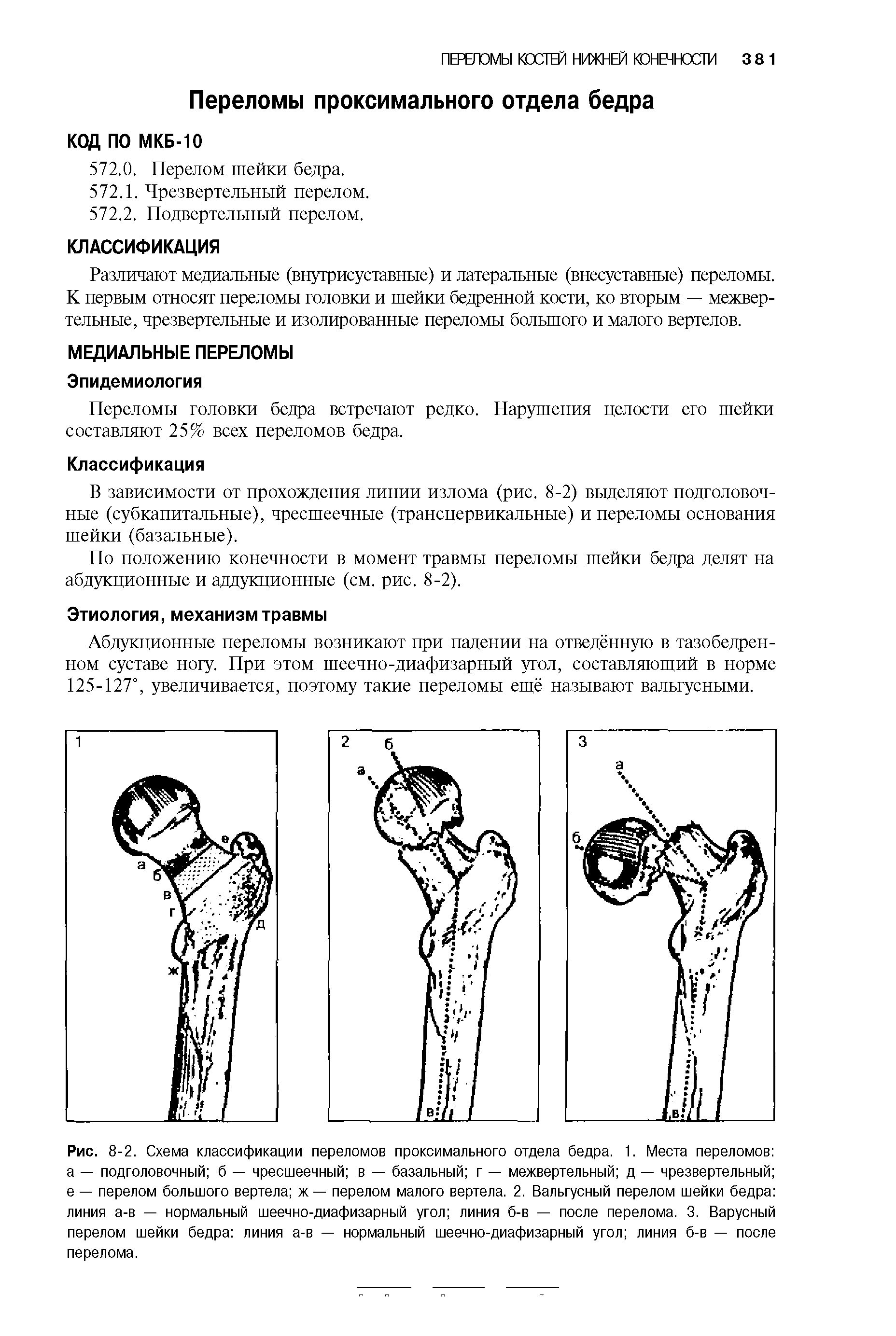Рис. 8-2. Схема классификации переломов проксимального отдела бедра. 1. Места переломов а — подголовочный б — чресшеечный в — базальный г — межвертельный д — чрезвертельный е — перелом большого вертела ж — перелом малого вертела. 2. Вальгусный перелом шейки бедра линия а-в — нормальный шеечно-диафизарный угол линия б-в — после перелома. 3. Варусный перелом шейки бедра линия а-в — нормальный шеечно-диафизарный угол линия б-в — после перелома.