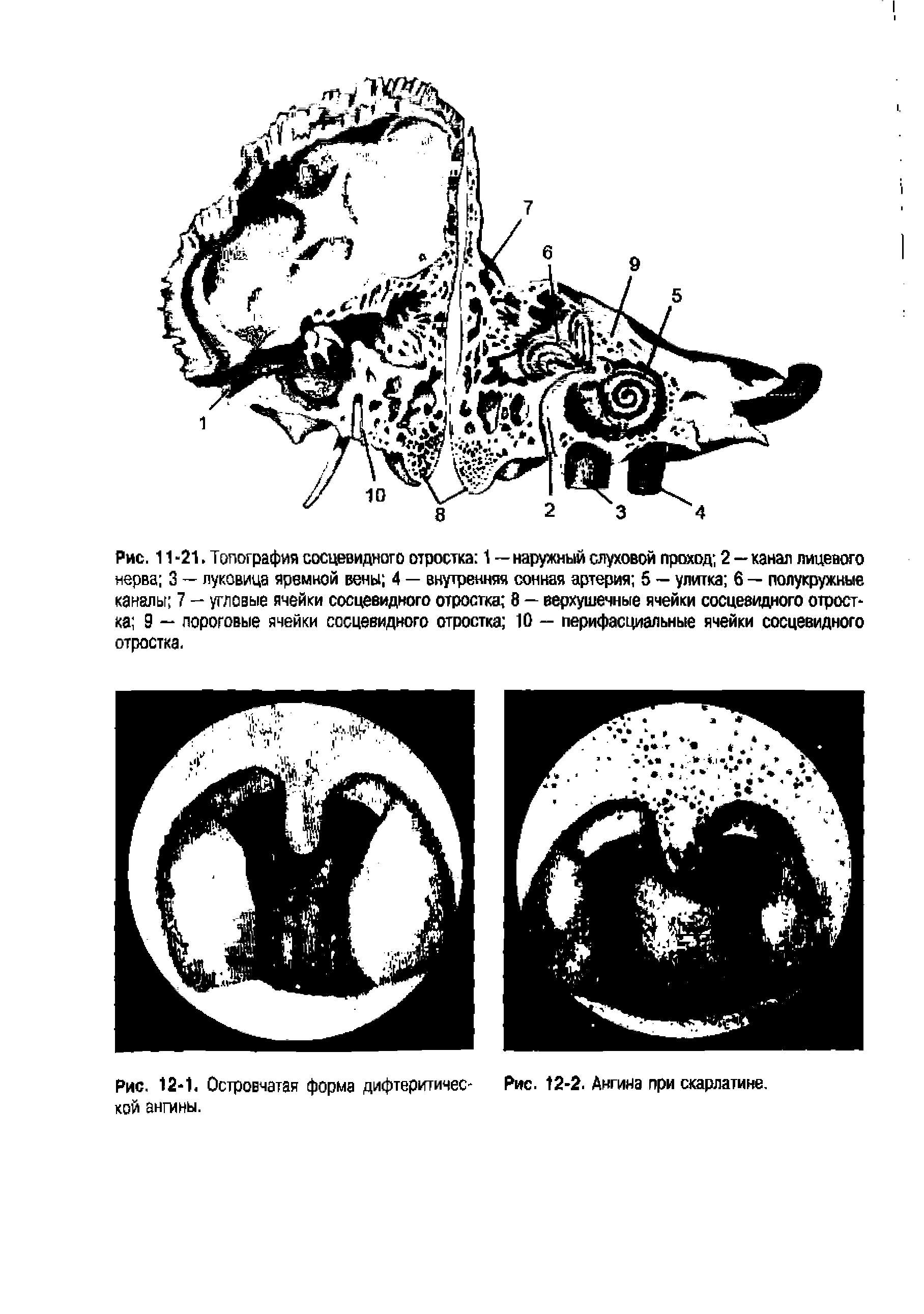 Рис. 12-1. Островчатая форма дифтеритичес- Рис. 12-2. Ангина при скарлатине, кой ангины.
