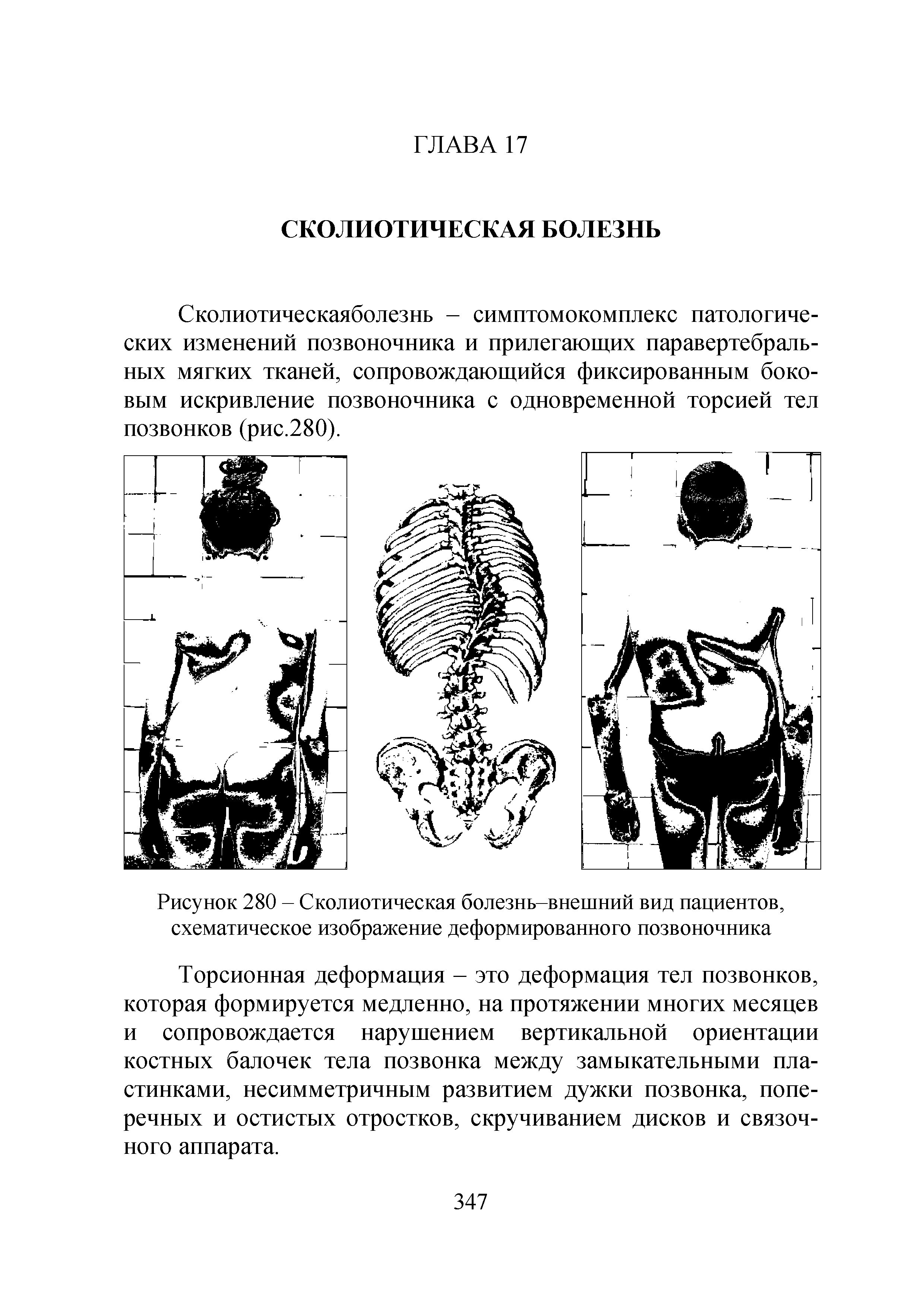 Рисунок 280 - Сколиотическая болезнь-внешний вид пациентов, схематическое изображение деформированного позвоночника...