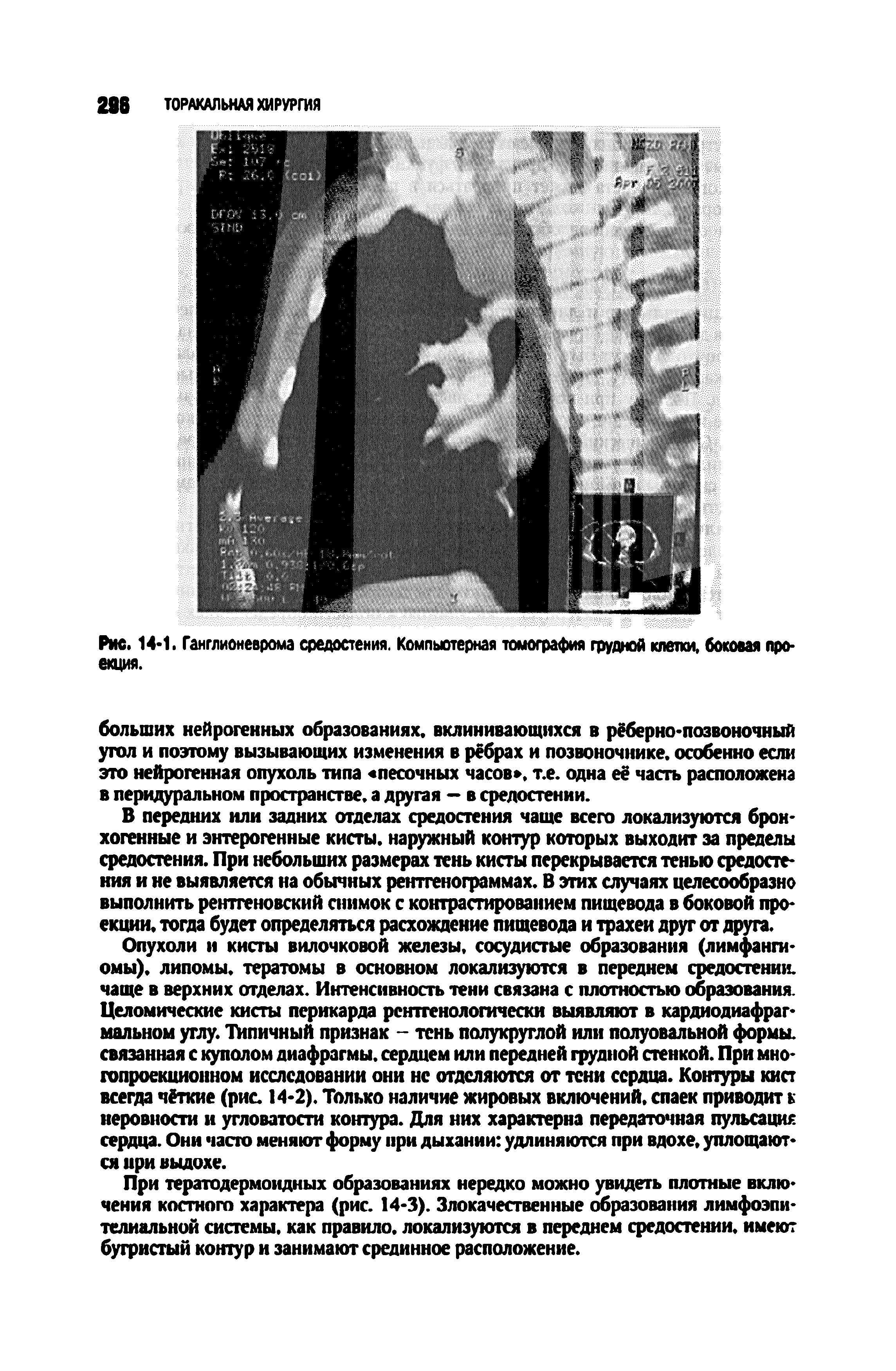 Рис. 14 1. Ганглионеврома средостения. Компьютерная томография грудной клетки, боковая проекция.