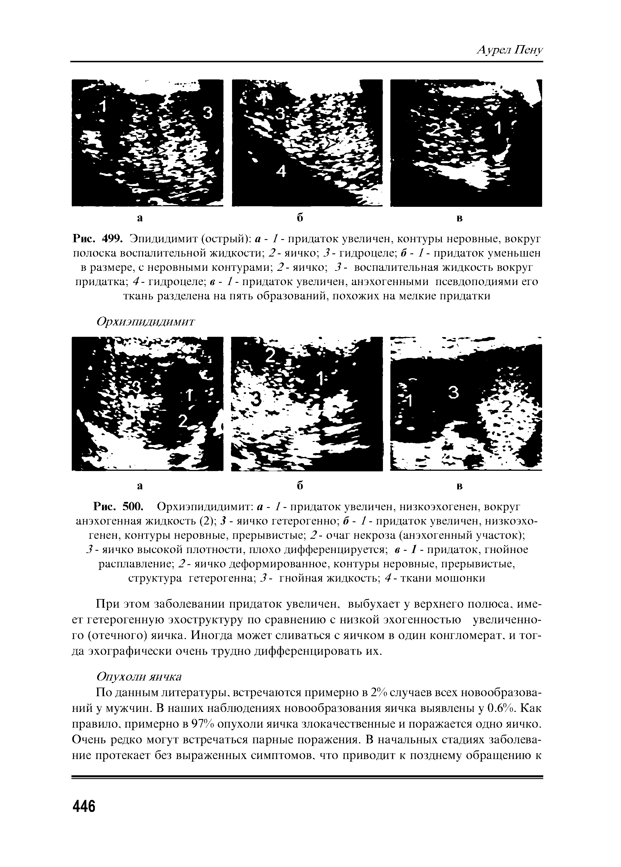 Рис. 499. Эпидидимит (острый) а - 1 - придаток увеличен, контуры неровные, вокруг полоска воспалительной жидкости 2- яичко 3- гидроцеле б - 1 - придаток уменьшен в размере, с неровными контурами 2- яичко 3 - воспалительная жидкость вокруг придатка 4- гидроцеле в - 1 - придаток увеличен, анэхогенными псевдоподиями его ткань разделена на пять образований, похожих на мелкие придатки...