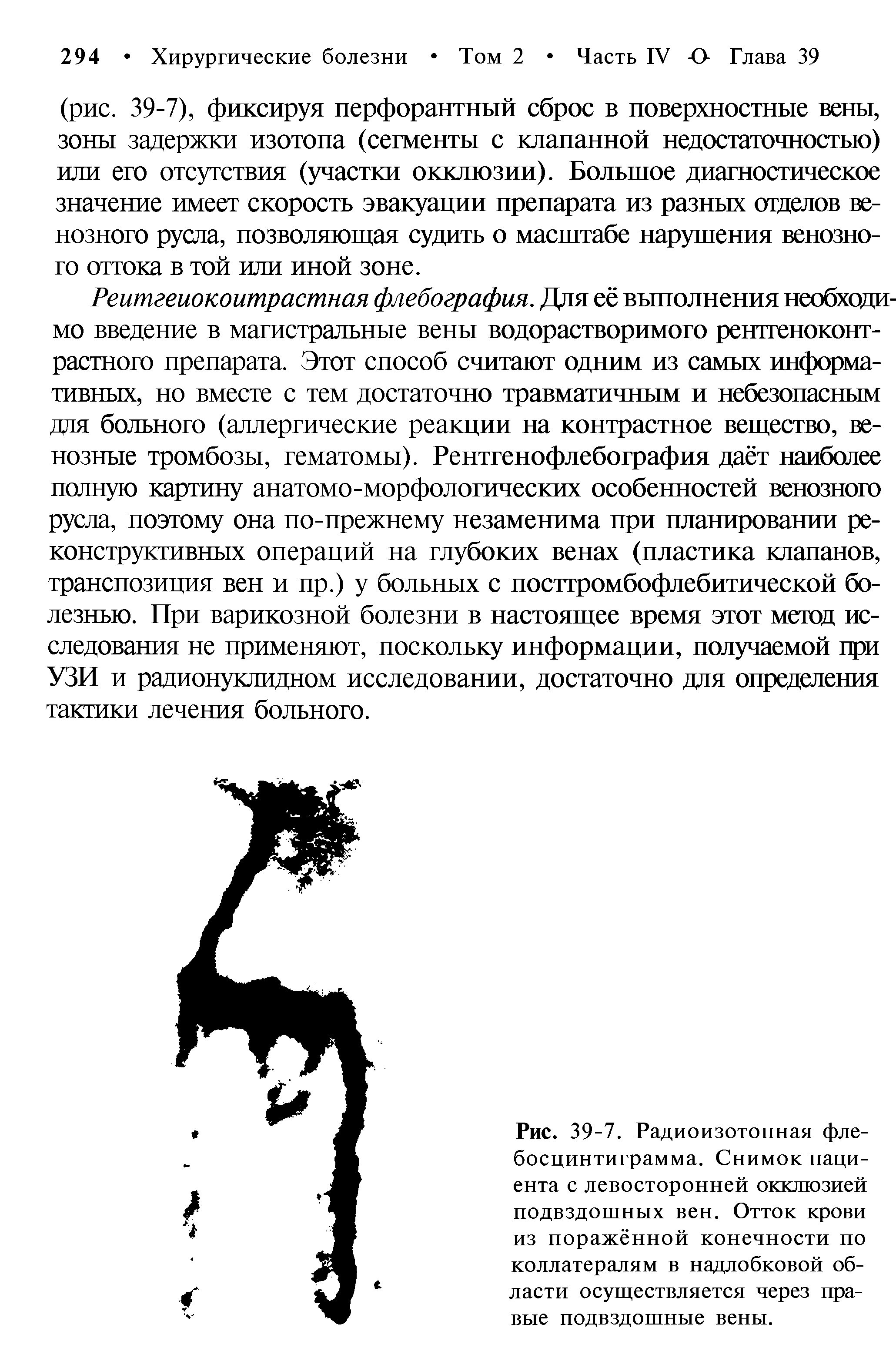 Рис. 39-7. Радиоизотопная фле-босцинтиграмма. Снимок пациента с левосторонней окклюзией подвздошных вен. Отток крови из поражённой конечности по коллатералям в надлобковой области осуществляется через правые подвздошные вены.