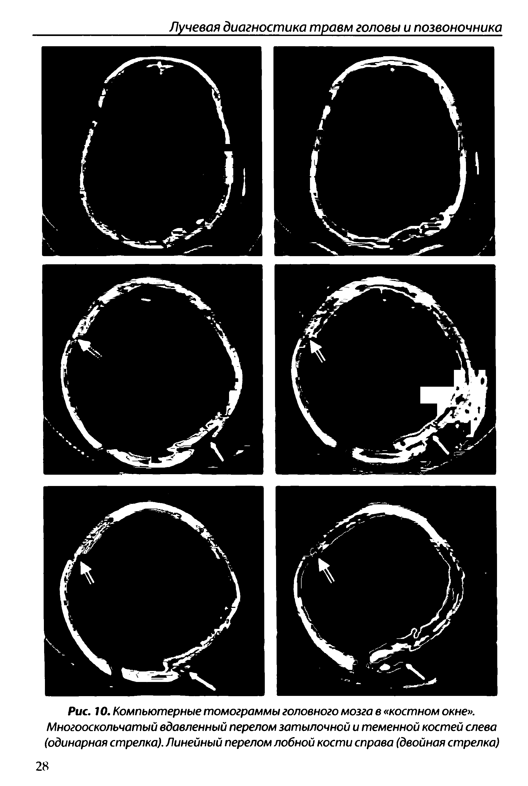 Рис. 10. Компьютерные томограммы головного мозга в костном окне . Многооскольчатый вдавленный перелом затылочной и теменной костей слева (одинарная стрелка). Линейный перелом лобной кости справа (двойная стрелка)...