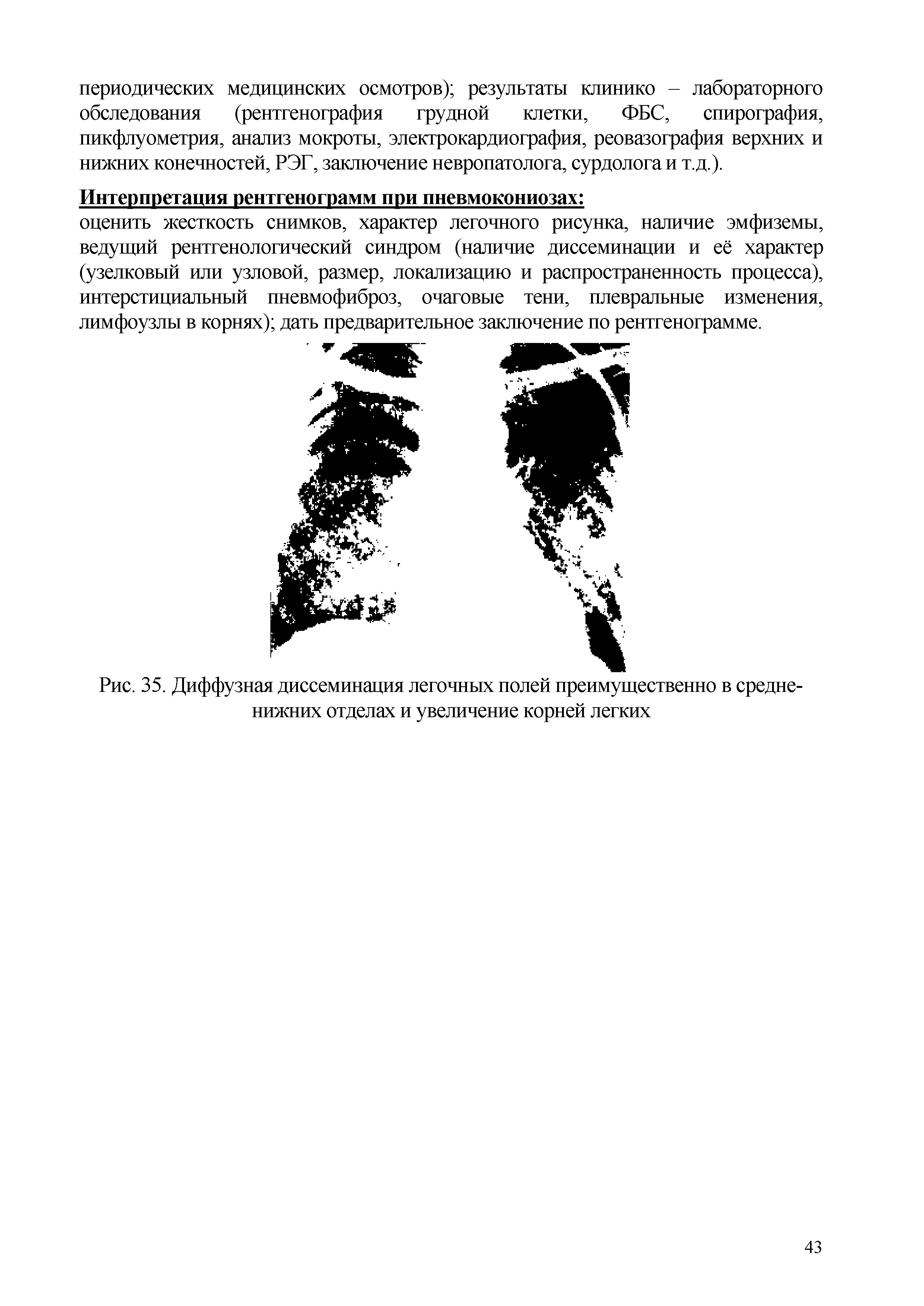 Рис. 35. Диффузная диссеминация легочных полей преимущественно в средненижних отделах и увеличение корней легких...