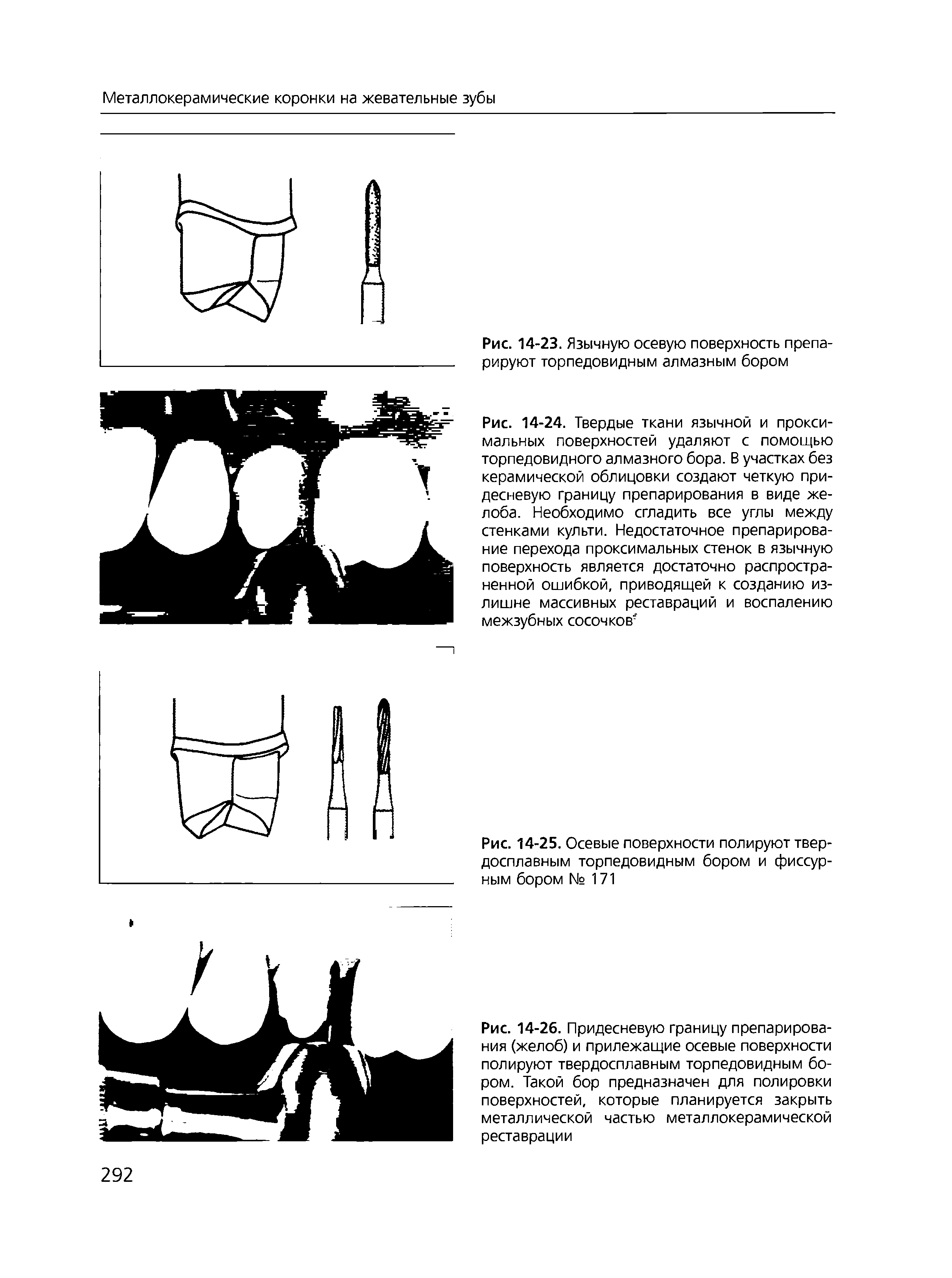 Рис. 14-26. Придесневую границу препарирования (желоб) и прилежащие осевые поверхности полируют твердосплавным торпедовидным бором. Такой бор предназначен для полировки поверхностей, которые планируется закрыть металлической частью металлокерамической реставрации...