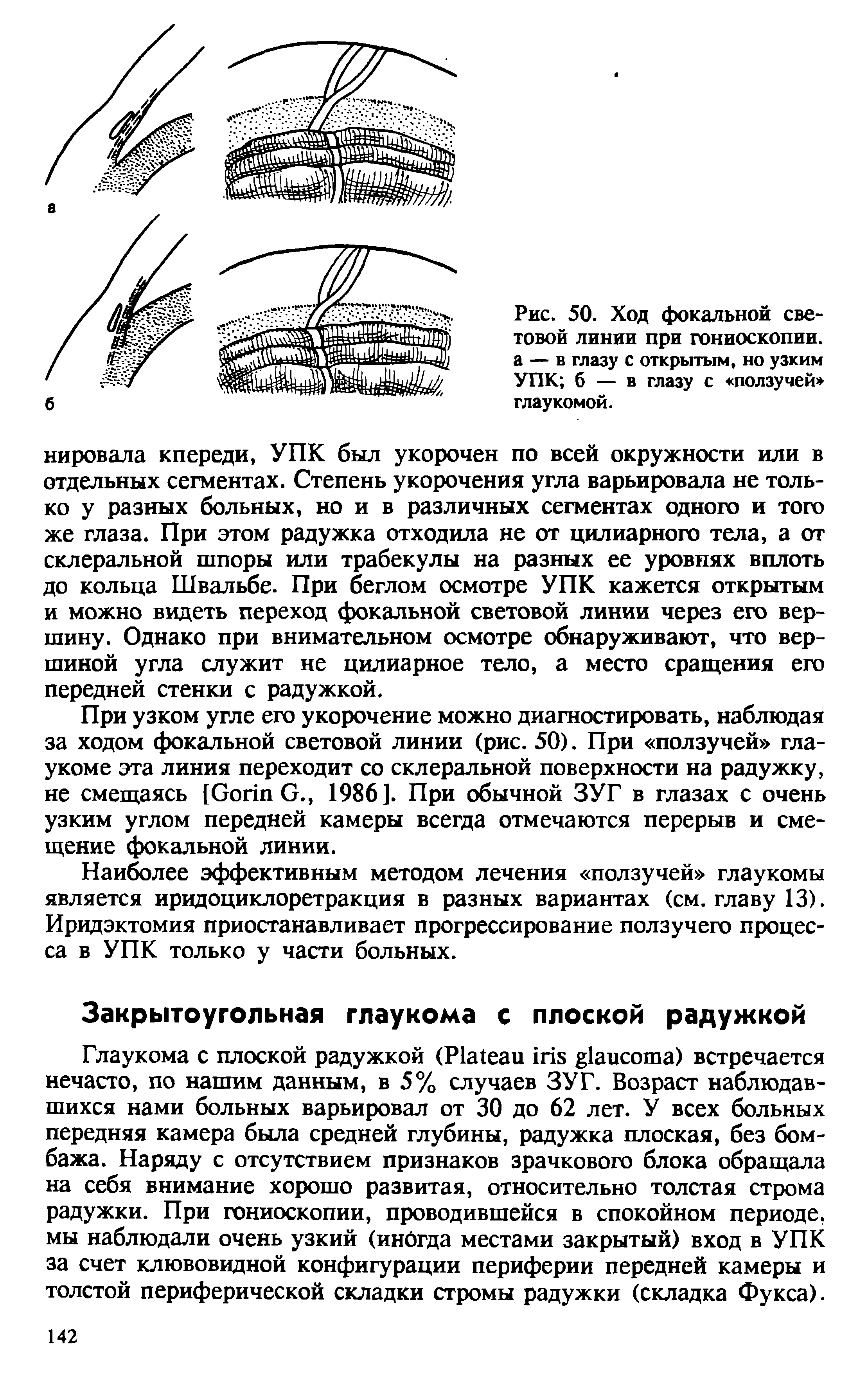 Рис. 50. Ход фокальной световой линии при гониоскопии, а — в глазу с открытым, но узким УПК б — в глазу с ползучей глаукомой.