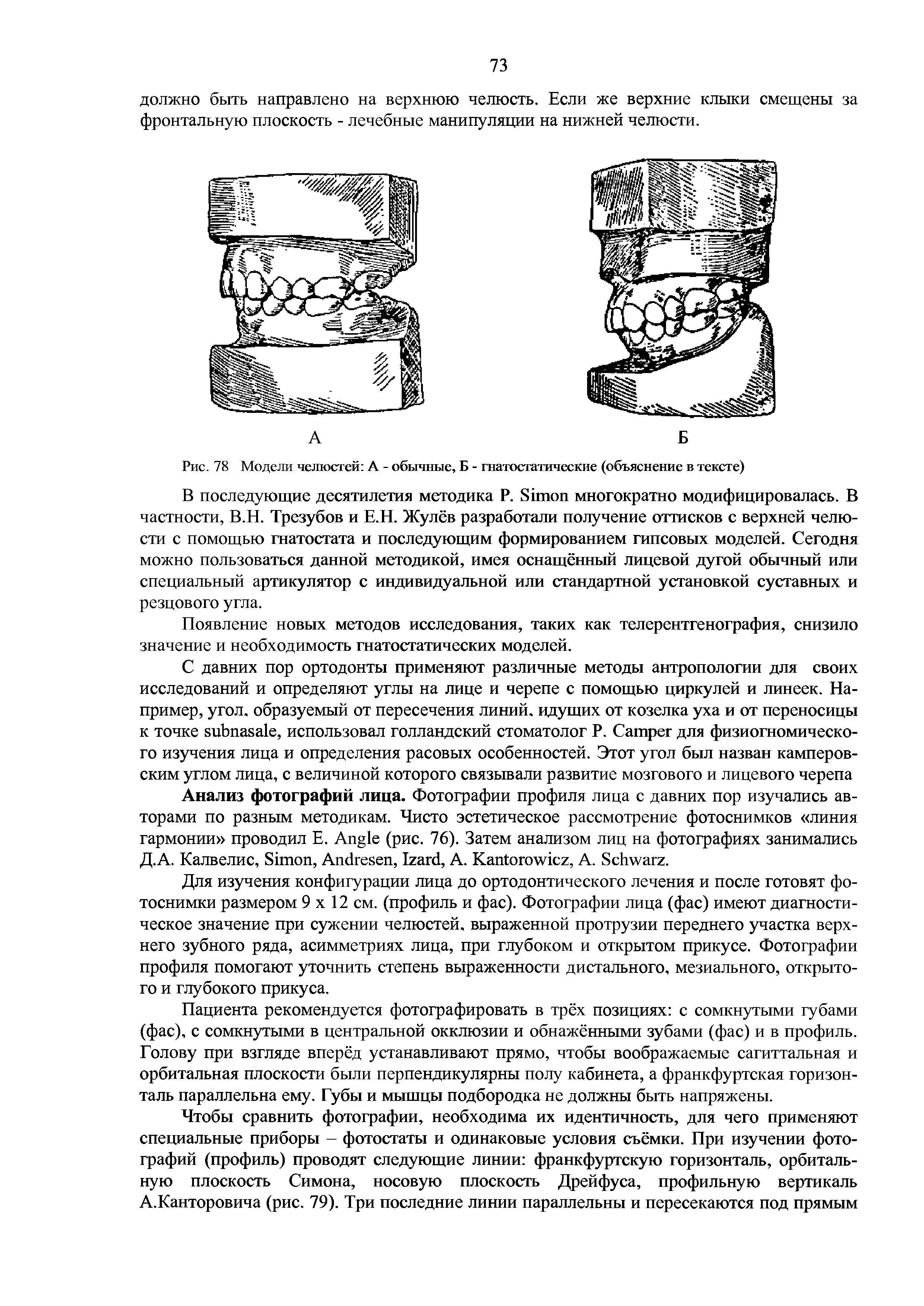 Рис. 78 Модели челюстей А - обычные, Б - гнатостатические (объяснение в тексте)...