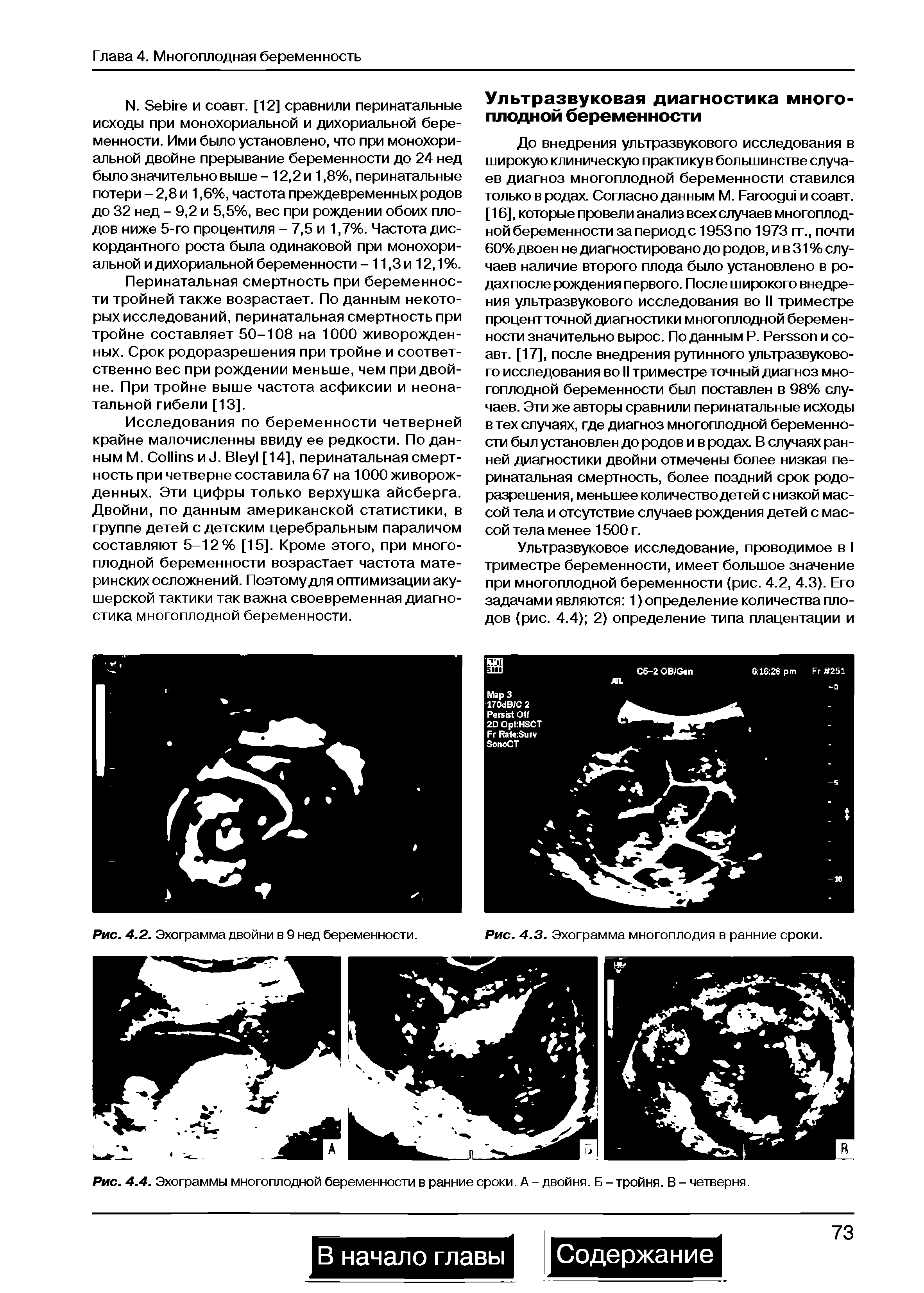 Рис. 4.4. Эхограммы многоплодной беременности в ранние сроки. А - двойня. Б - тройня. В - четверня.