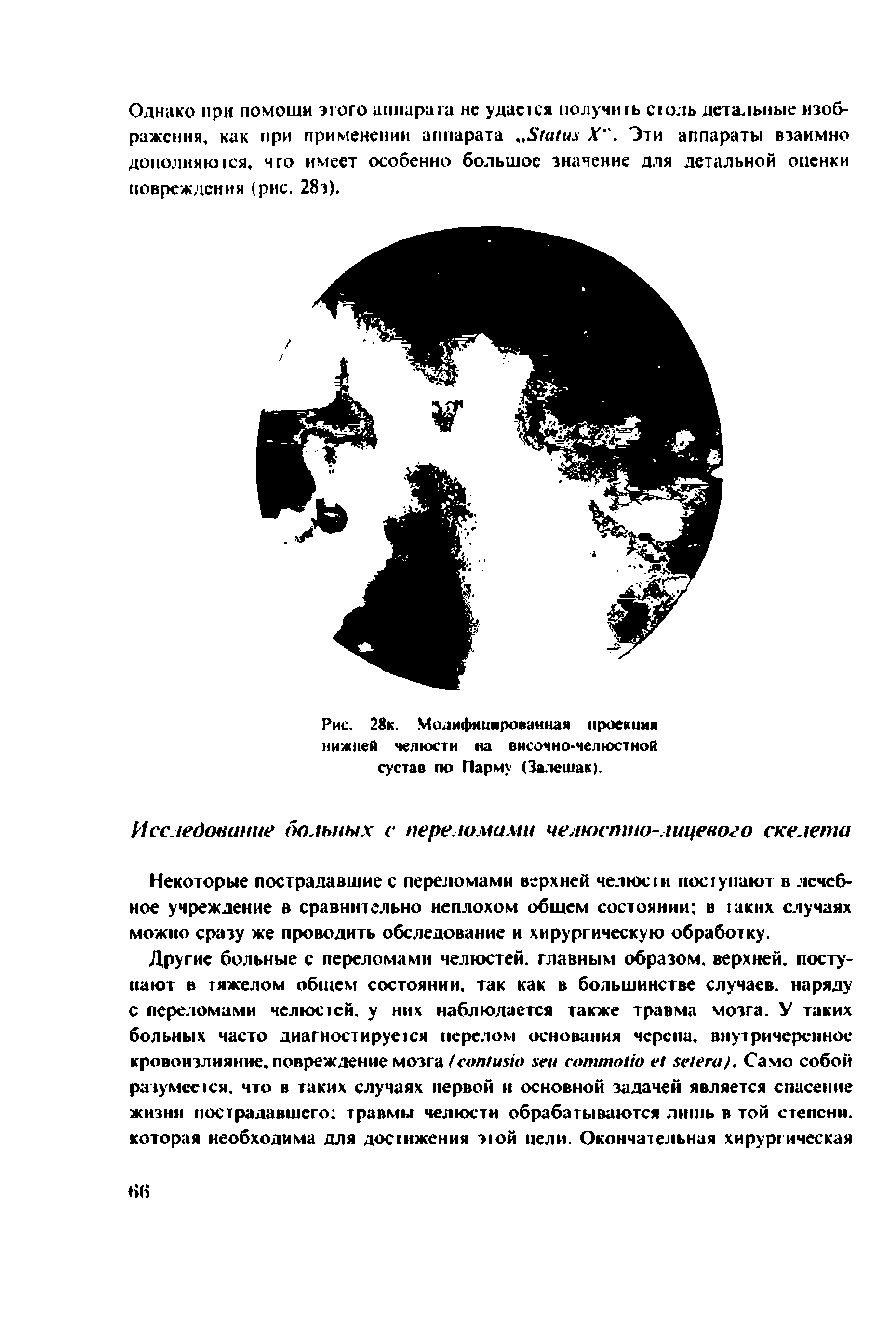 Рис. 28к. Модифицированная проекция нижней челюсти на височно-челюстной сустав по Парму (Залешак).