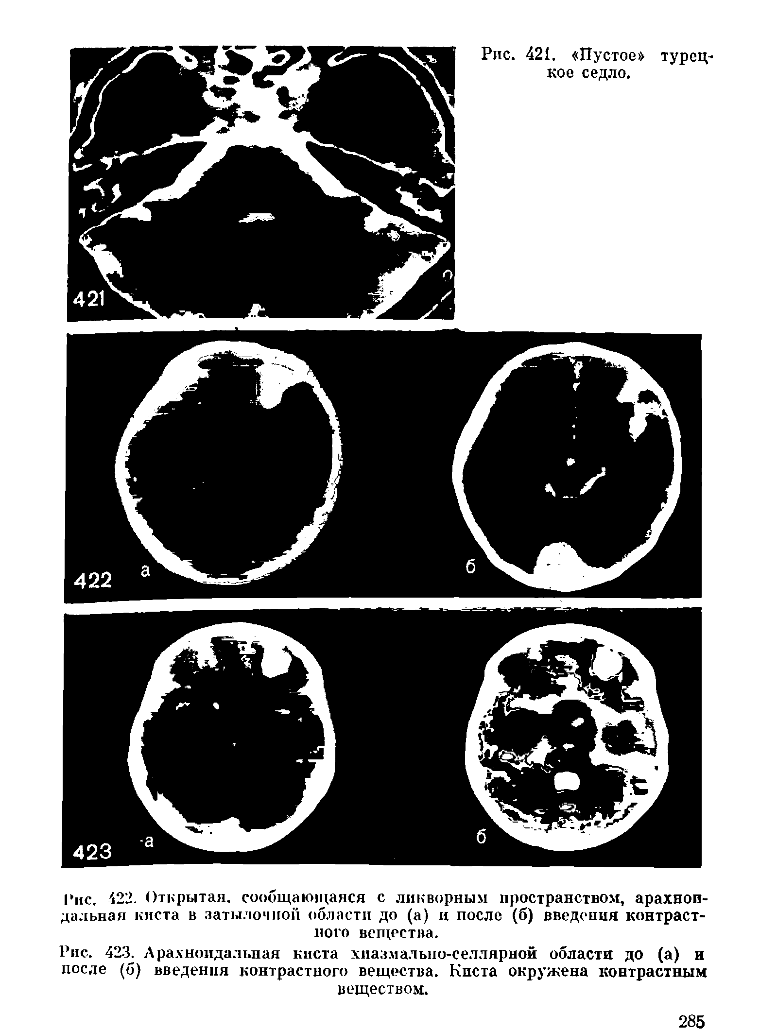 Рис. 423. Арахноидальная киста хиазмально-селлярной области до (а) и после (б) введения контрастного вещества. Киста окружена контрастным веществом.