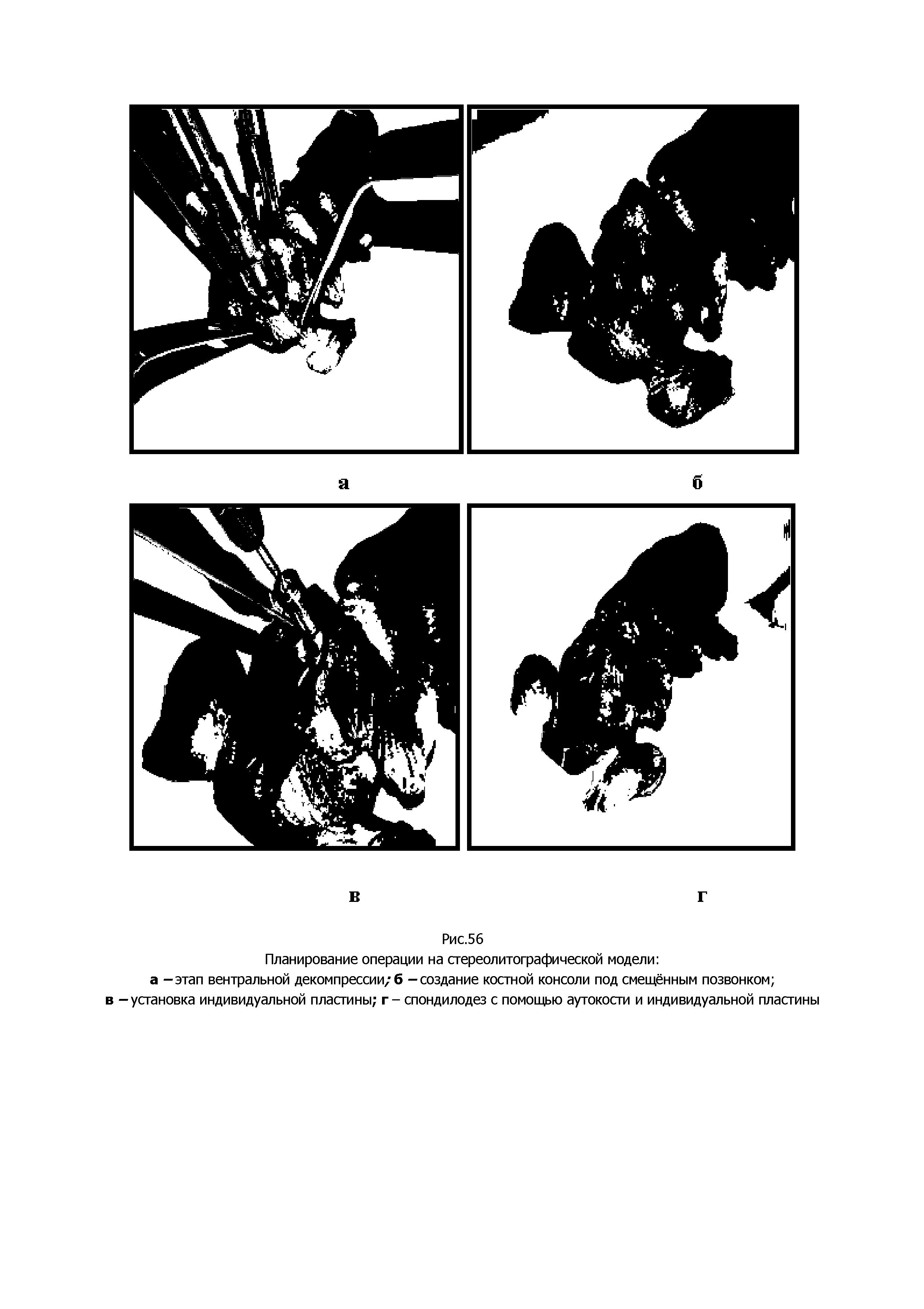 Рис.56 Планирование операции на стереолитографической модели а -этап вентральной декомпрессии/б - создание костной консоли под смещённым позвонком в -установка индивидуальной пластины г - спондилодез с помощью аутокости и индивидуальной пластины...