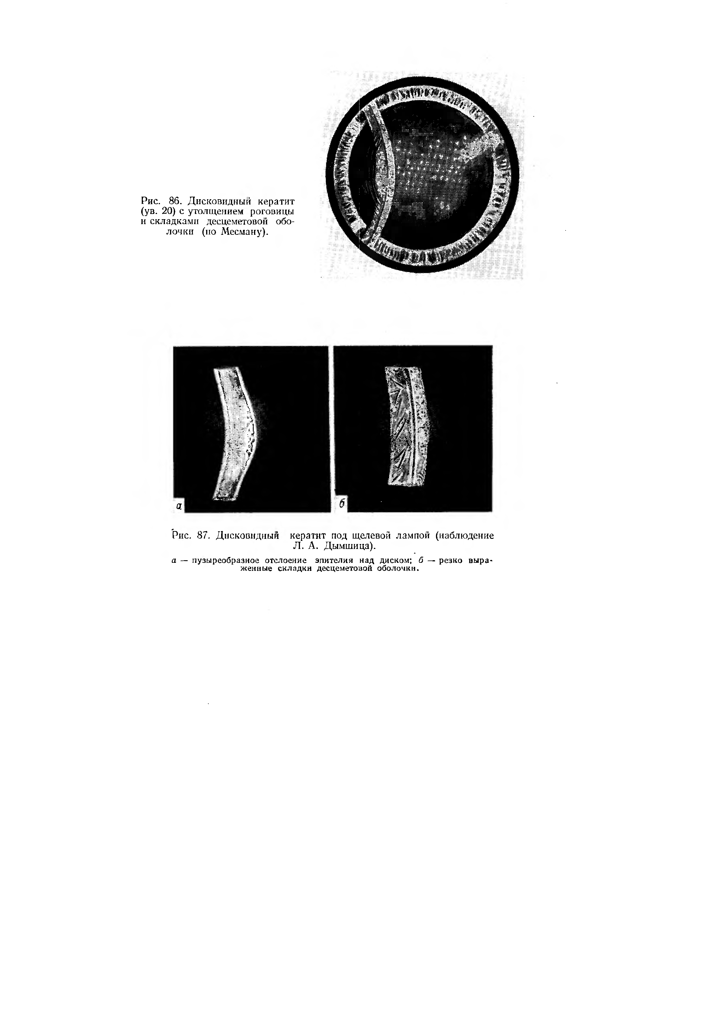 Рис. 87. Дисковидный кератит под щелевой лампой (наблюдение Л. А. Дымшица).