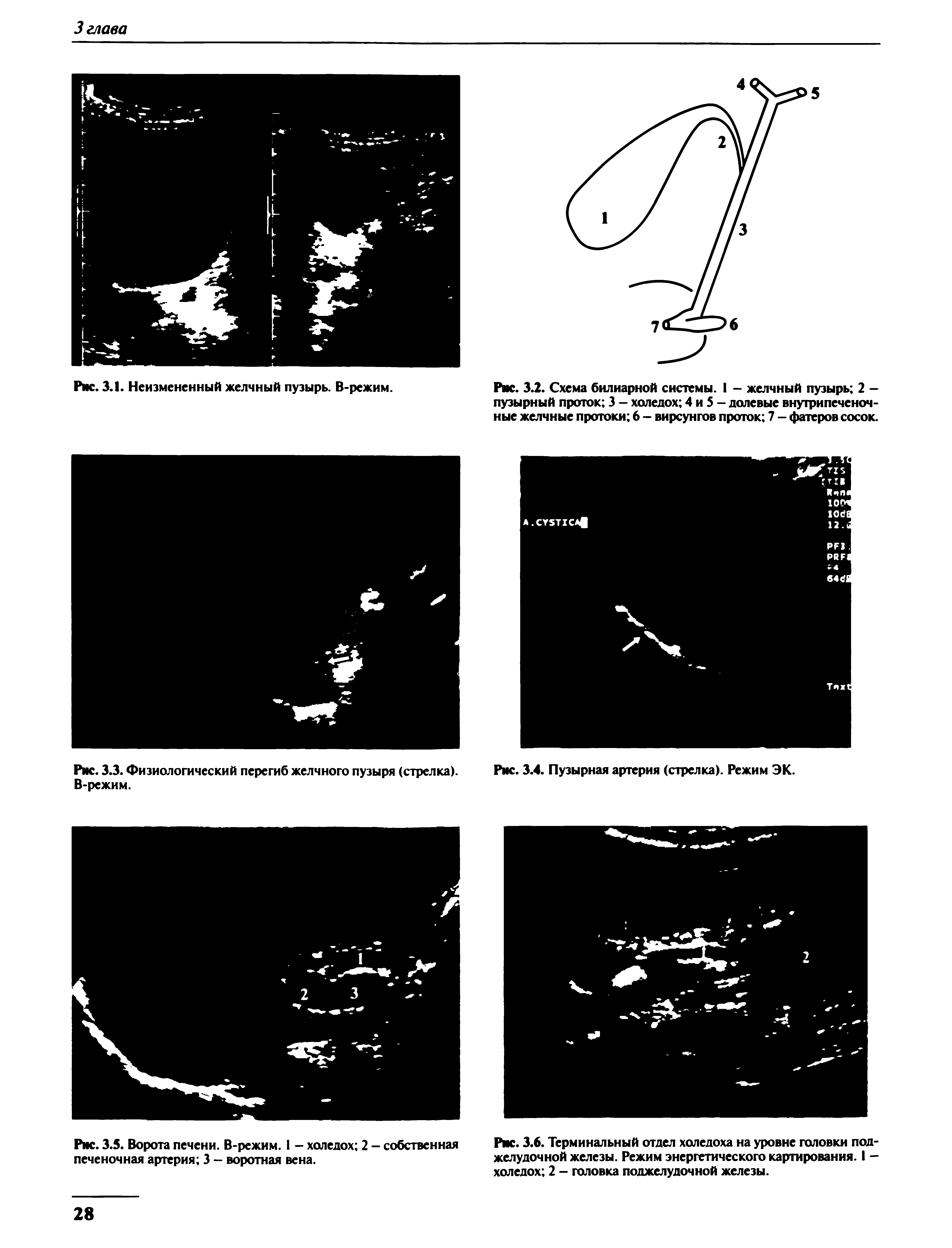 Рис. 3.3. Физиологический перегиб желчного пузыря (стрелка). В-режим.