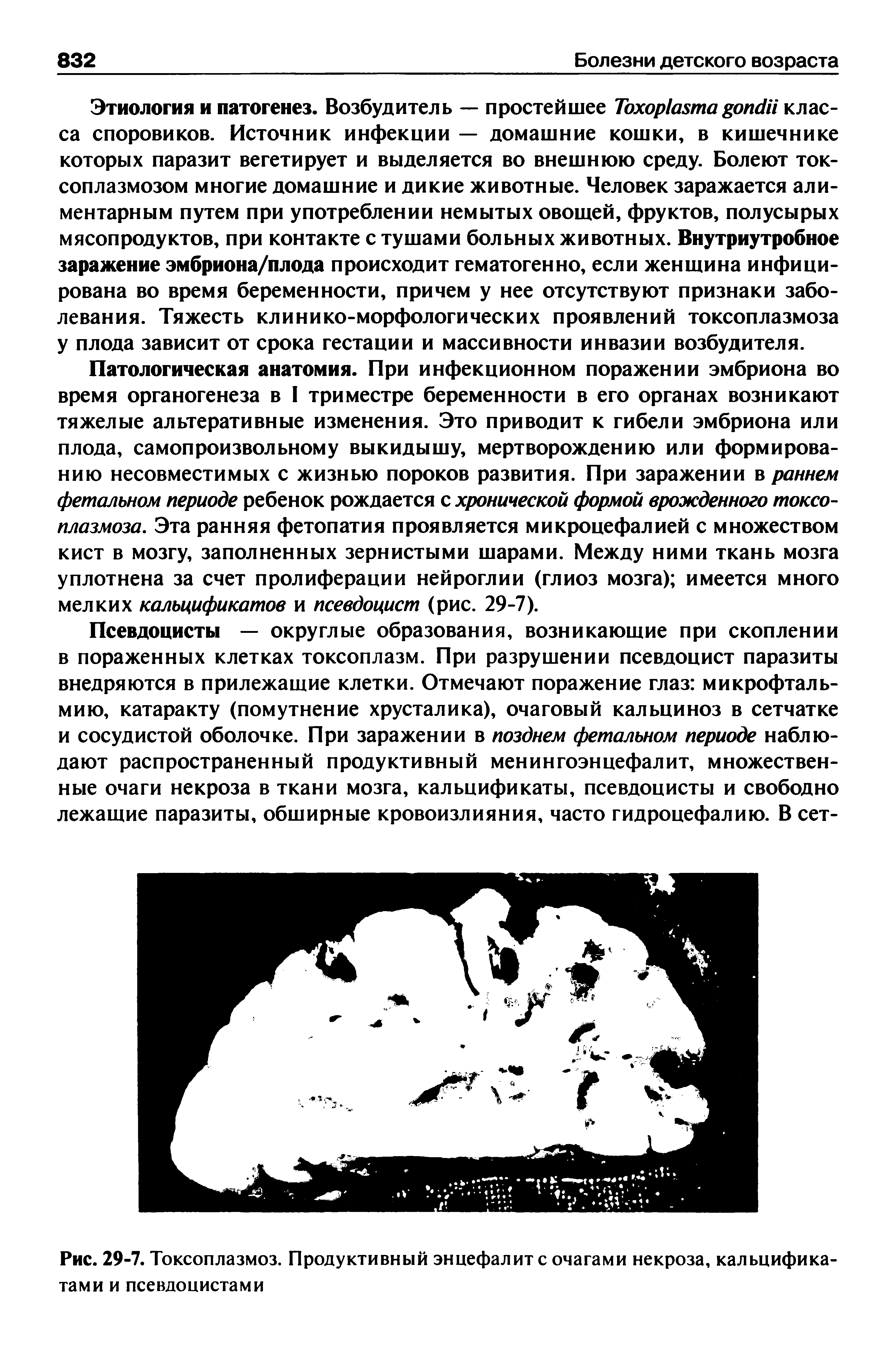 Рис. 29-7. Токсоплазмоз. Продуктивный энцефалите очагами некроза, кальцифика-тами и псевдоцистами...