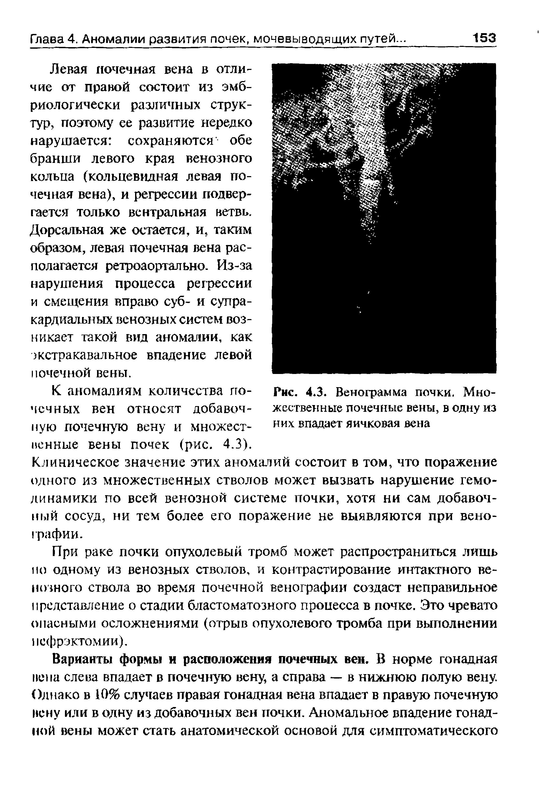 Рис. 4.3. Венограмма почки. Множественные почечные вены, в одну из них впадает яичковая вена...