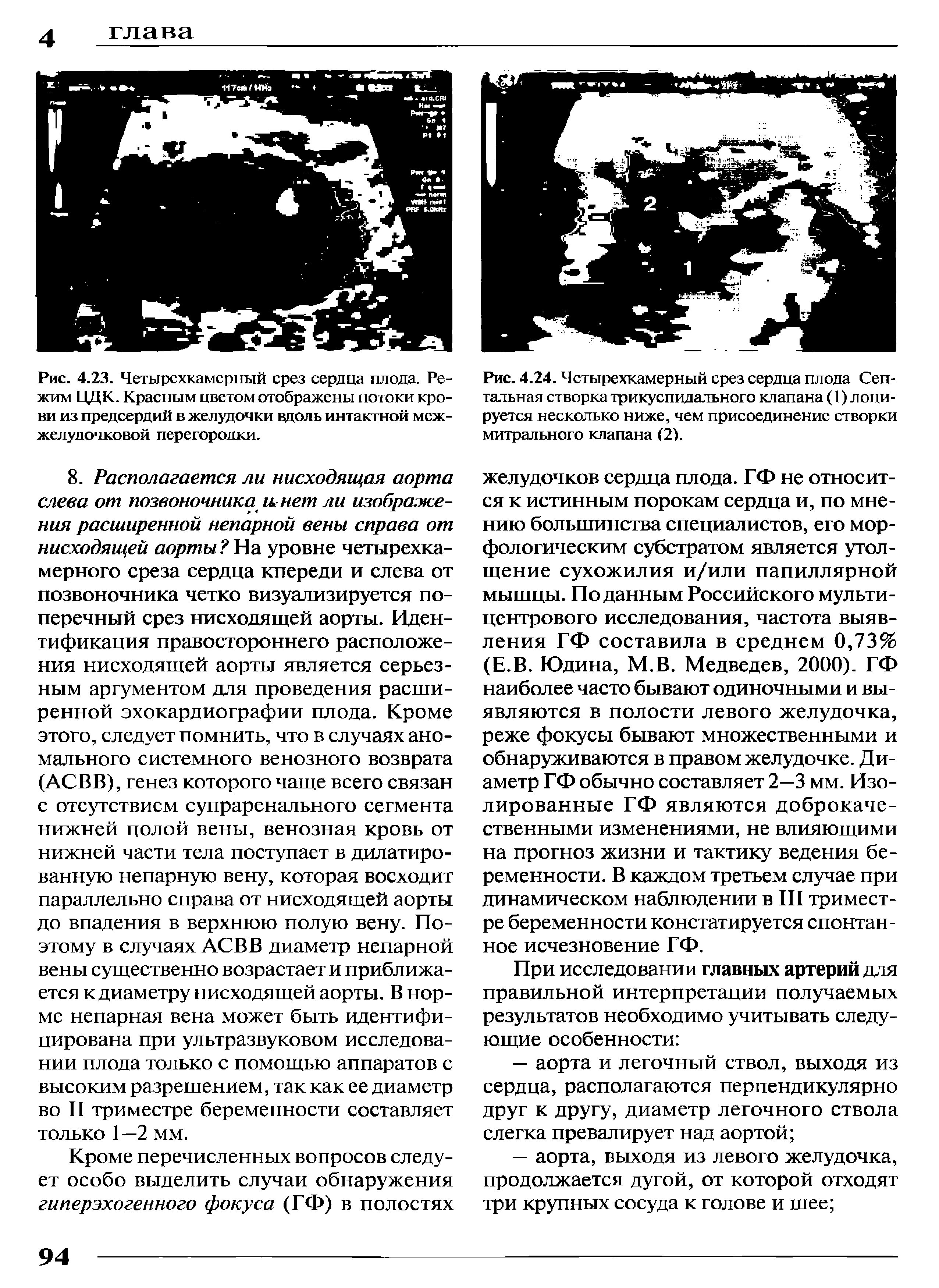 Рис. 4.23. Четырехкамерный срез сердца плода. Режим ЦЦК. Красным цветом отображены потоки крови из предсердий в желудочки вдоль интактной межжелудочковой перегородки.