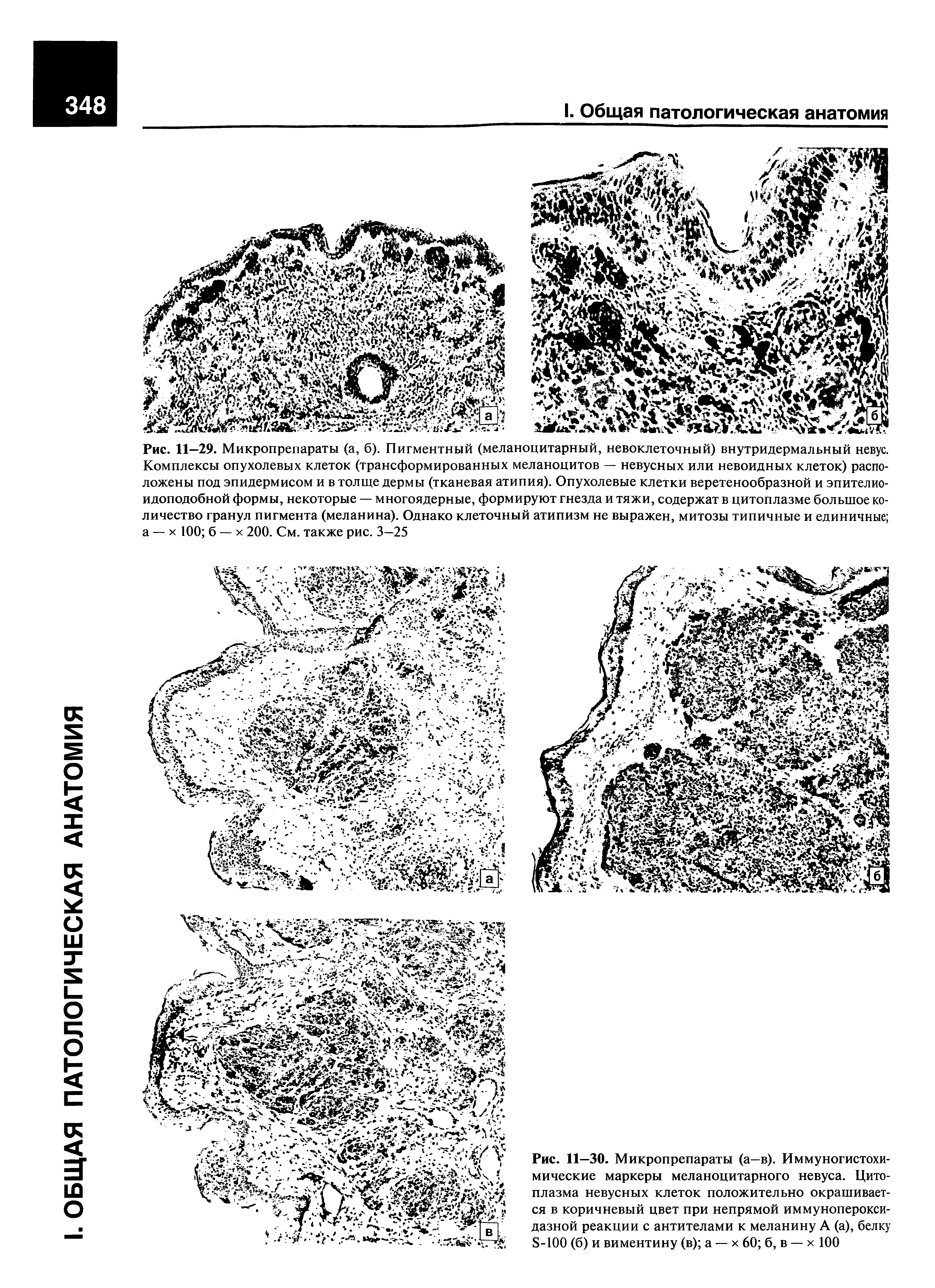 Рис. 11—30. Микропрепараты (а—в). Иммуногистохимические маркеры меланоцитарного невуса. Цитоплазма невусных клеток положительно окрашивается в коричневый цвет при непрямой иммунопероксидазной реакции с антителами к меланину А (а), белку 8-100 (б) и виментину (в) а — х 60 б, в — х 100...