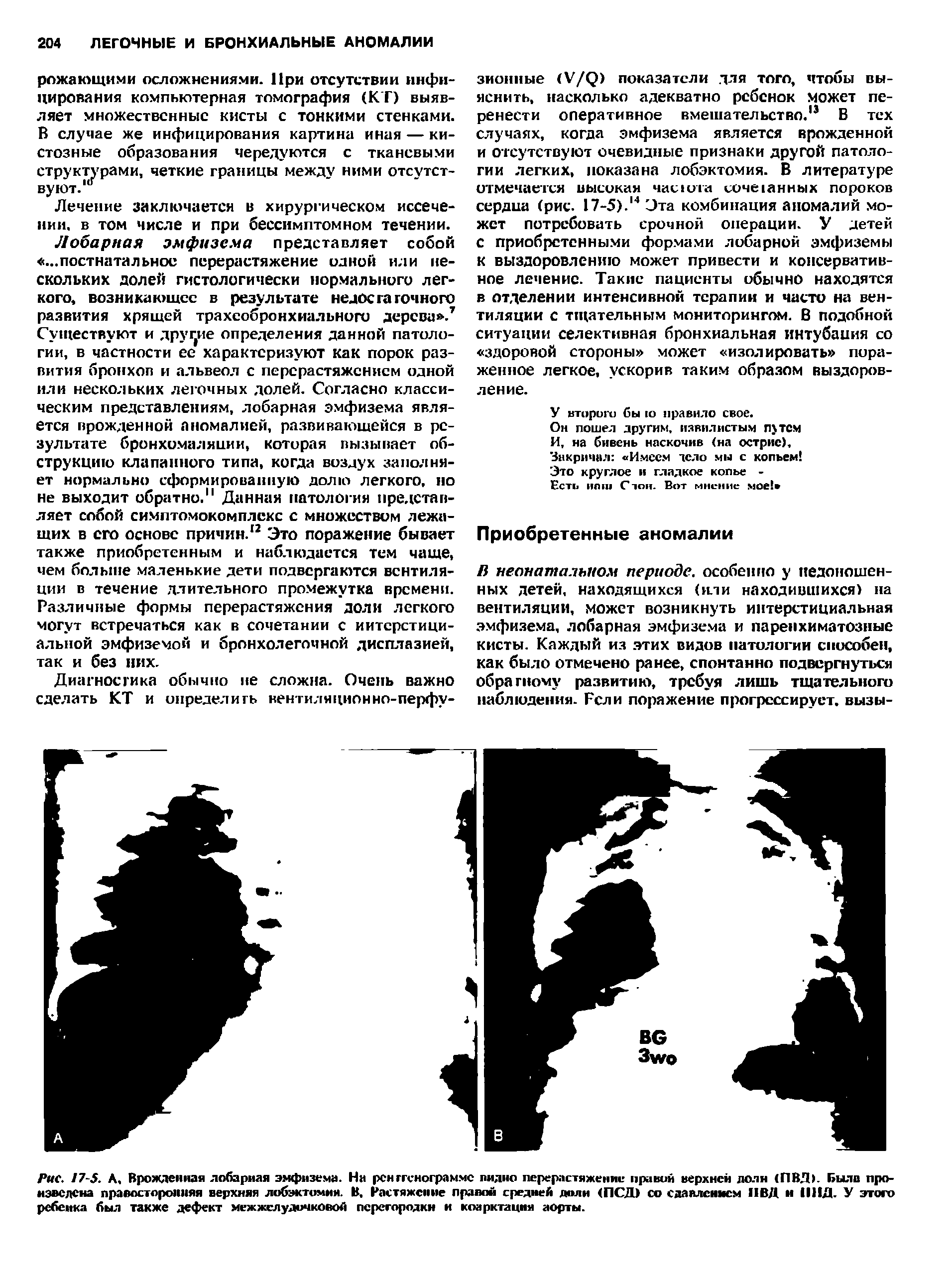 Рис. I7-S. А, Врожденная лобарная эмфизема. На рентгенограмме пидио перерастяжение правой верхней доля <ПВД). Была произведена правосторонняя верхняя лобэктомия. В. Растяжение правой средней доли <ПСД> со сдавлением 11ВД и 1111Д. У этого ребенка был также дефект межжелудочковой перегородки и коарктация аорты.