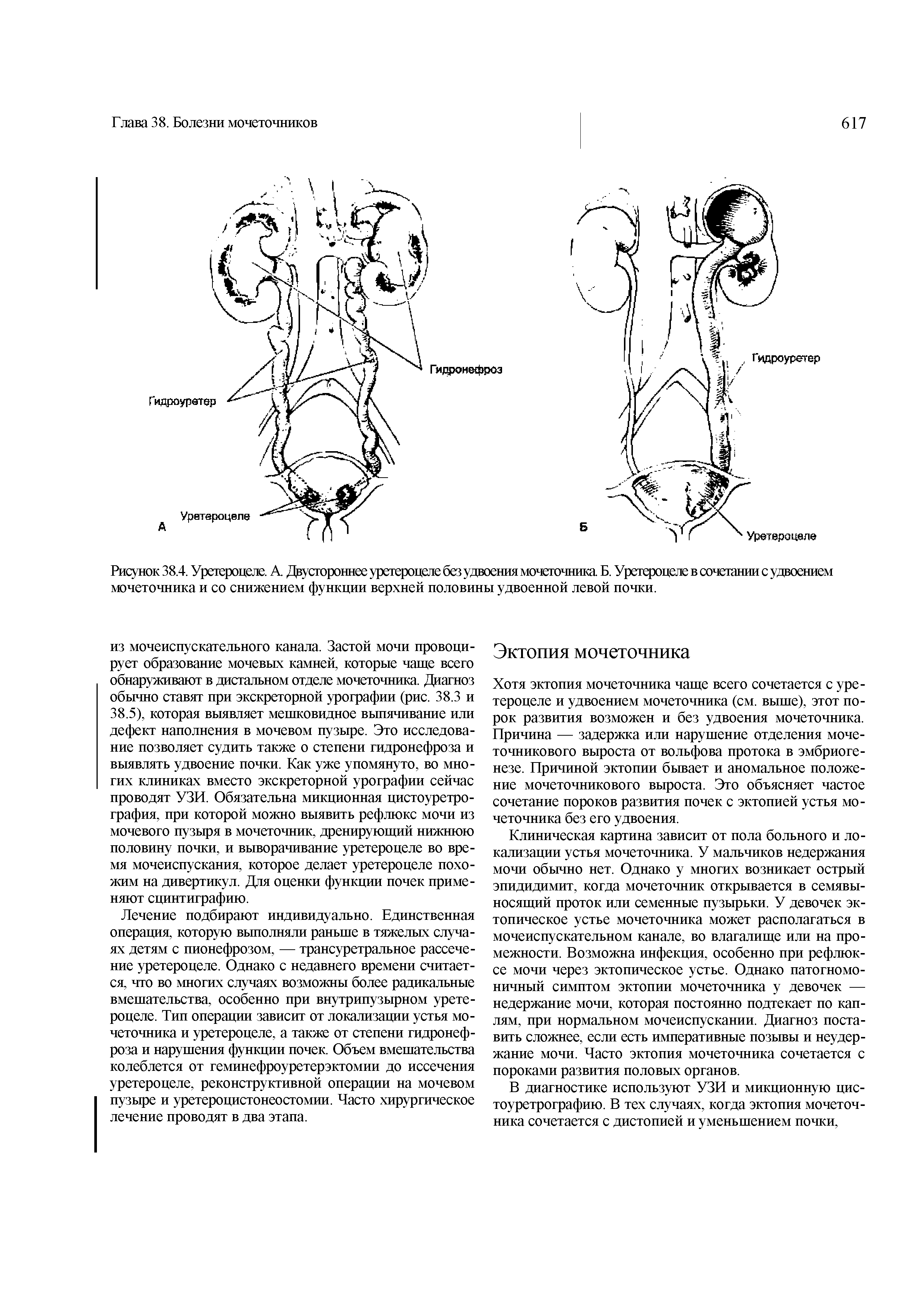 Рисунок 38.4. Уретероцеле. А. Двустороннее уретероцеле без удвоения мочеточника Б. Уретероцеле в сочетании с удвоением мочеточника и со снижением функции верхней половины удвоенной левой почки.
