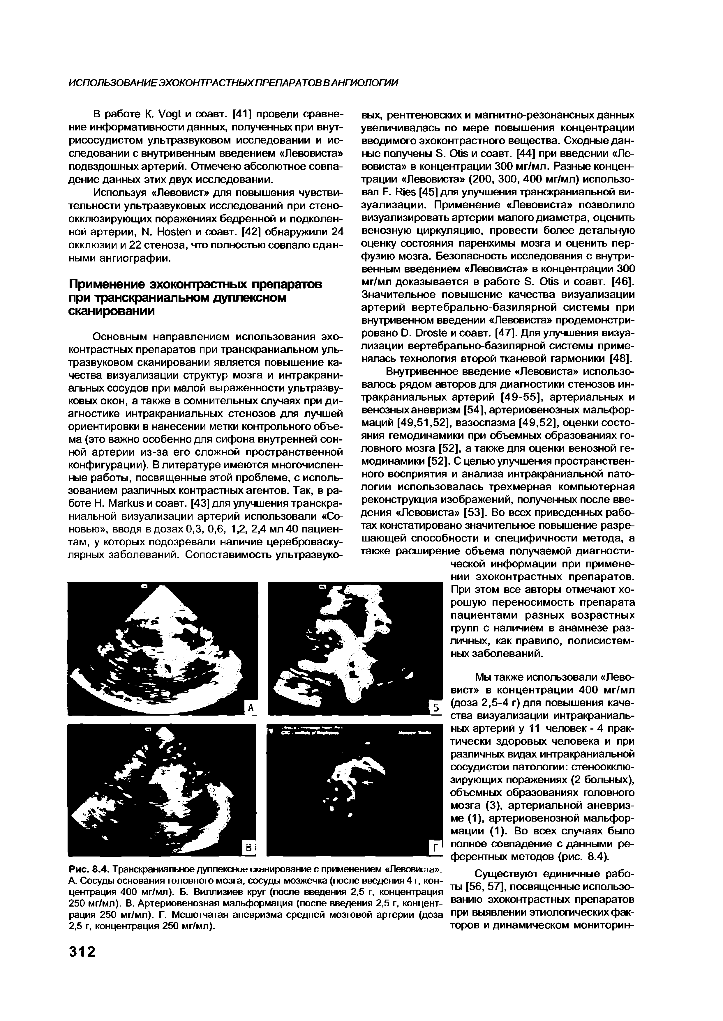 Рис. 8.4. Транскраниальное дуплексное сканирование с применением Левовис1а . А. Сосуды основания головного мозга, сосуды мозжечка (после введения 4 г, концентрация 400 мг/мл). Б. Виллизиев круг (после введения 2,5 г, концентрация 250 мг/мл). В. Артериовенозная мальформация (после введения 2,5 г, концентрация 250 мг/мл). Г. Мешотчатая аневризма средней мозговой артерии (доза 2,5 г, концентрация 250 мг/мл).