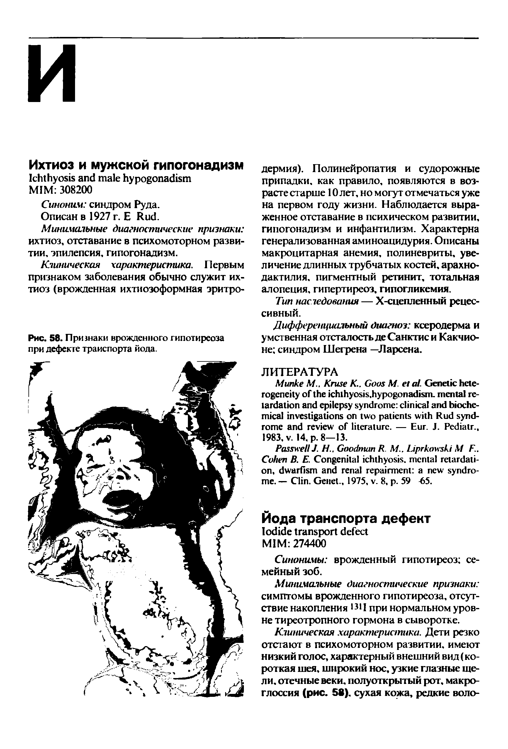 Рис. 58. Признаки врожденного гипотиреоза при дефекте транспорта йода.