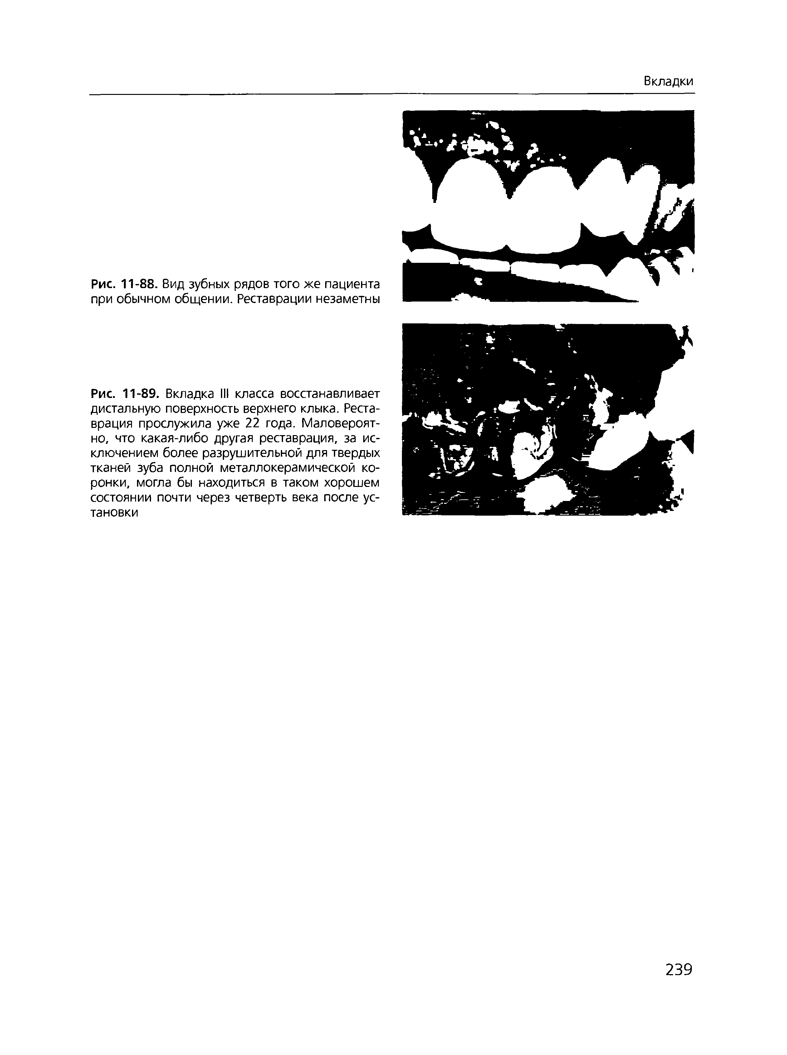 Рис. 11-89. Вкладка III класса восстанавливает дистальную поверхность верхнего клыка. Реставрация прослужила уже 22 года. Маловероятно, что какая-либо другая реставрация, за исключением более разрушительной для твердых тканей зуба полной металлокерамической коронки, могла бы находиться в таком хорошем состоянии почти через четверть века после установки...