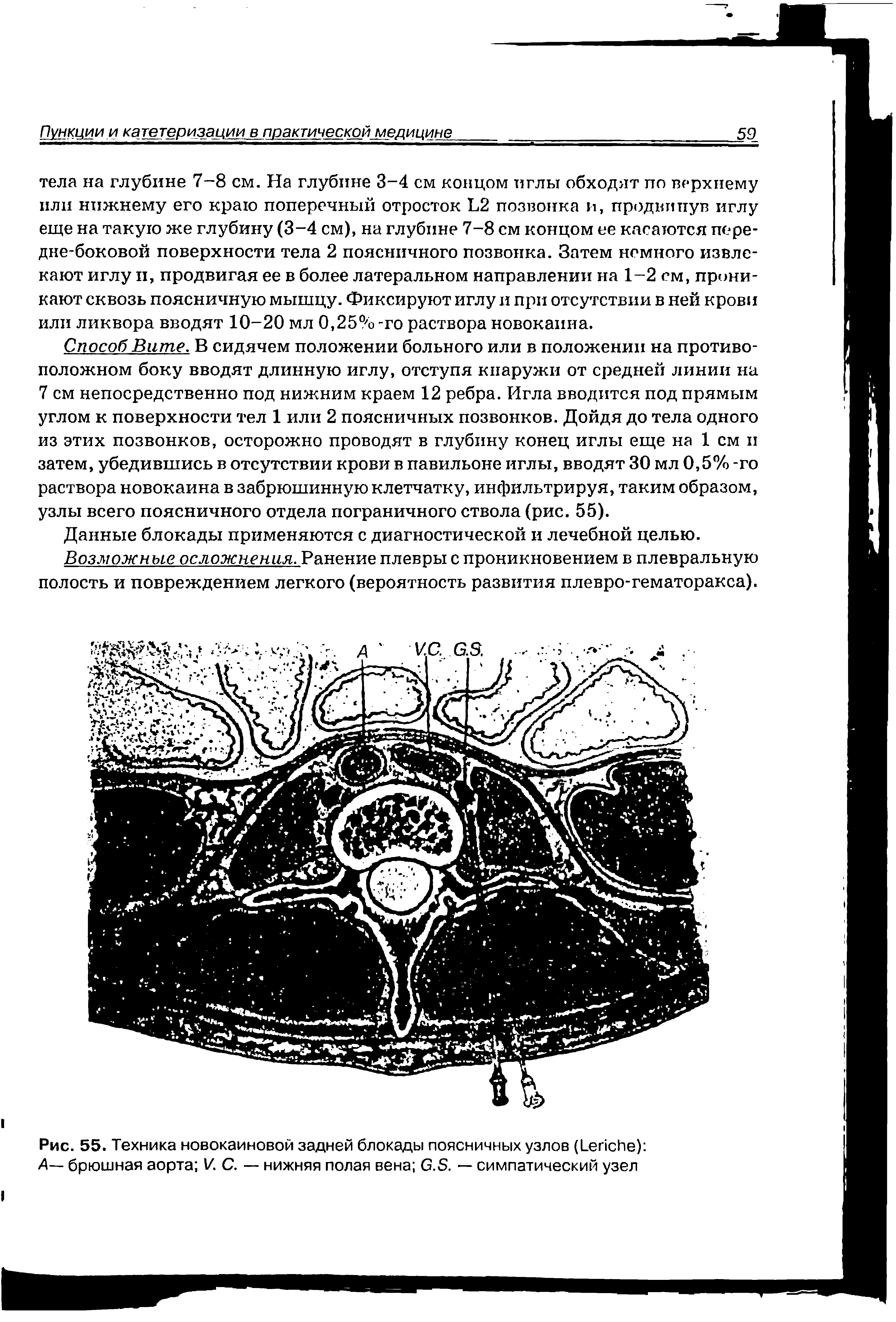 Рис. 55. Техника новокаиновой задней блокады поясничных узлов (1 епсИе) Д— брюшная аорта И С. — нижняя полая вена б.Б. — симпатический узел...