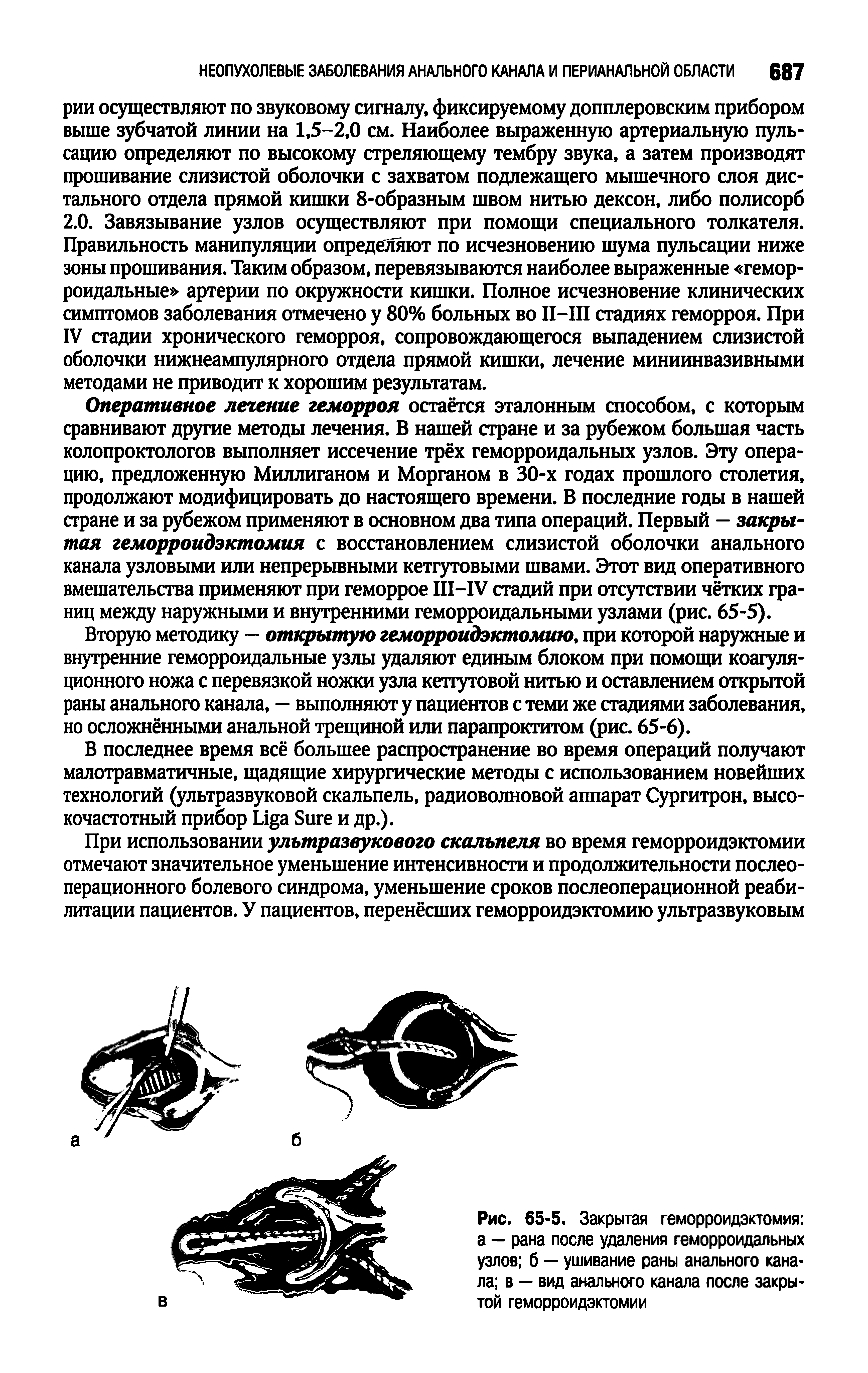 Рис. 65-5. Закрытая геморроидэктомия а — рана после удаления геморроидальных узлов б — ушивание раны анального канала в — вид анального канала после закрытой геморроидэктомии...