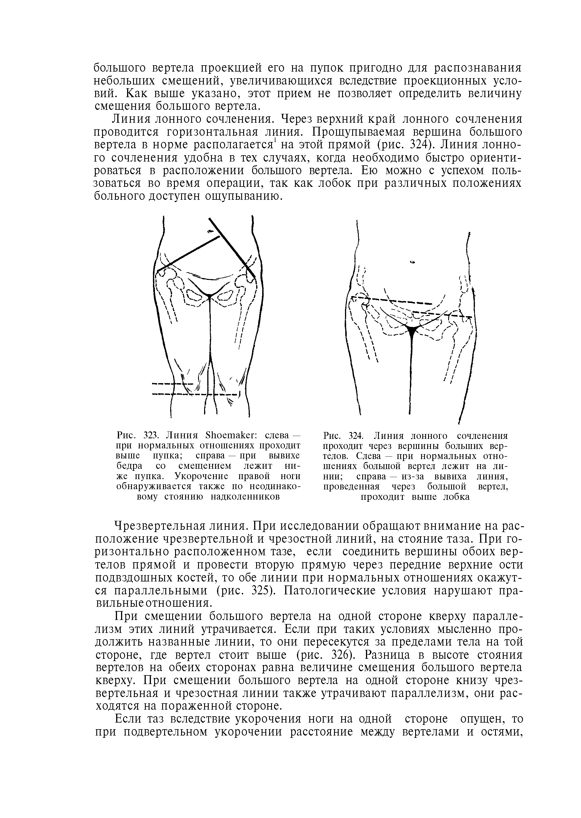 Рис. 324. Линия лонного сочленения проходит через вершины больших вертелов. Слева — при нормальных отношениях большой вертел лежит на линии справа — из-за вывиха линия, проведенная через большой вертел, проходит выше лобка...