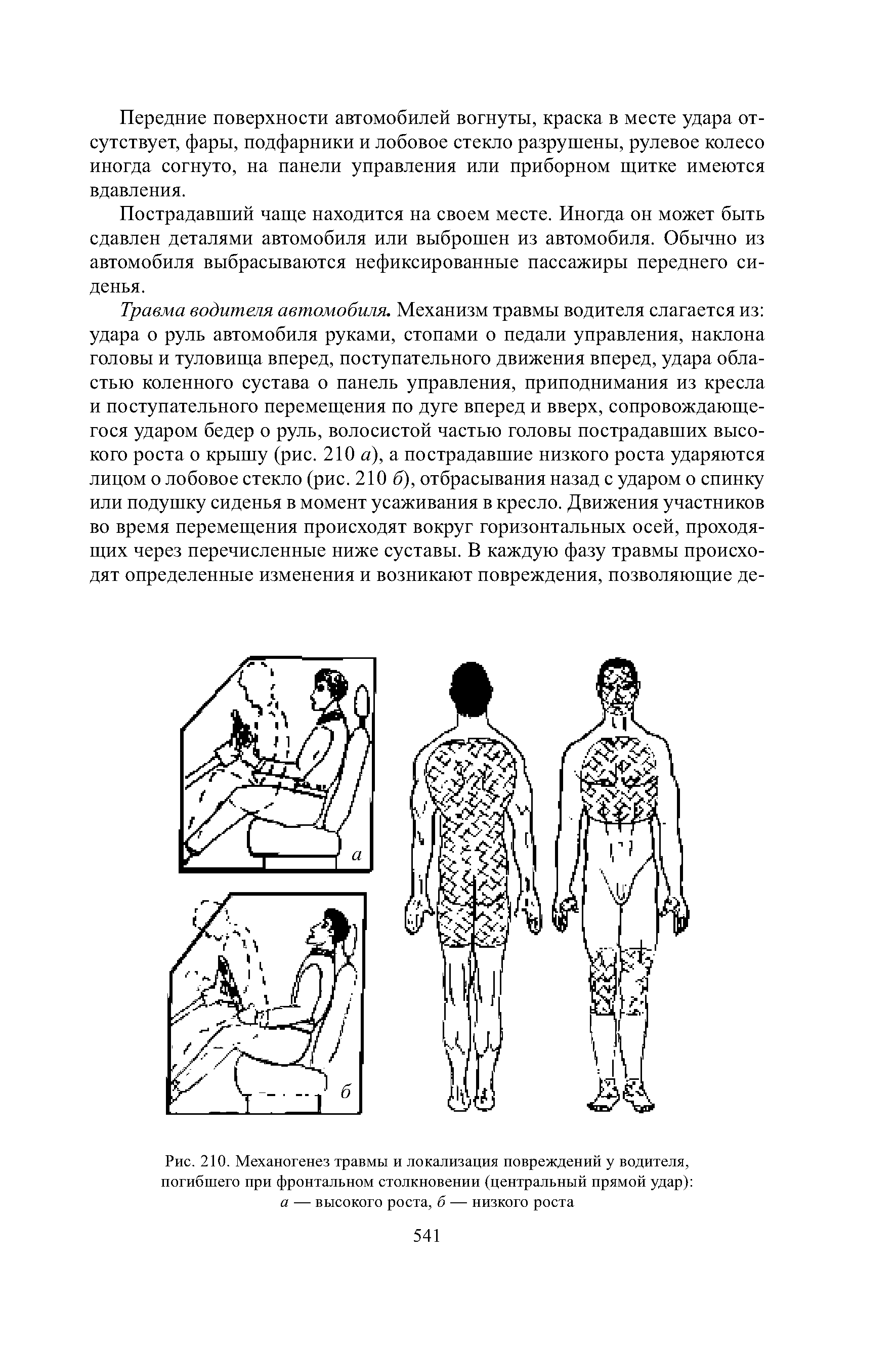 Рис. 210. Механогенез травмы и локализация повреждений у водителя, погибшего при фронтальном столкновении (центральный прямой удар) а — высокого роста, б — низкого роста...
