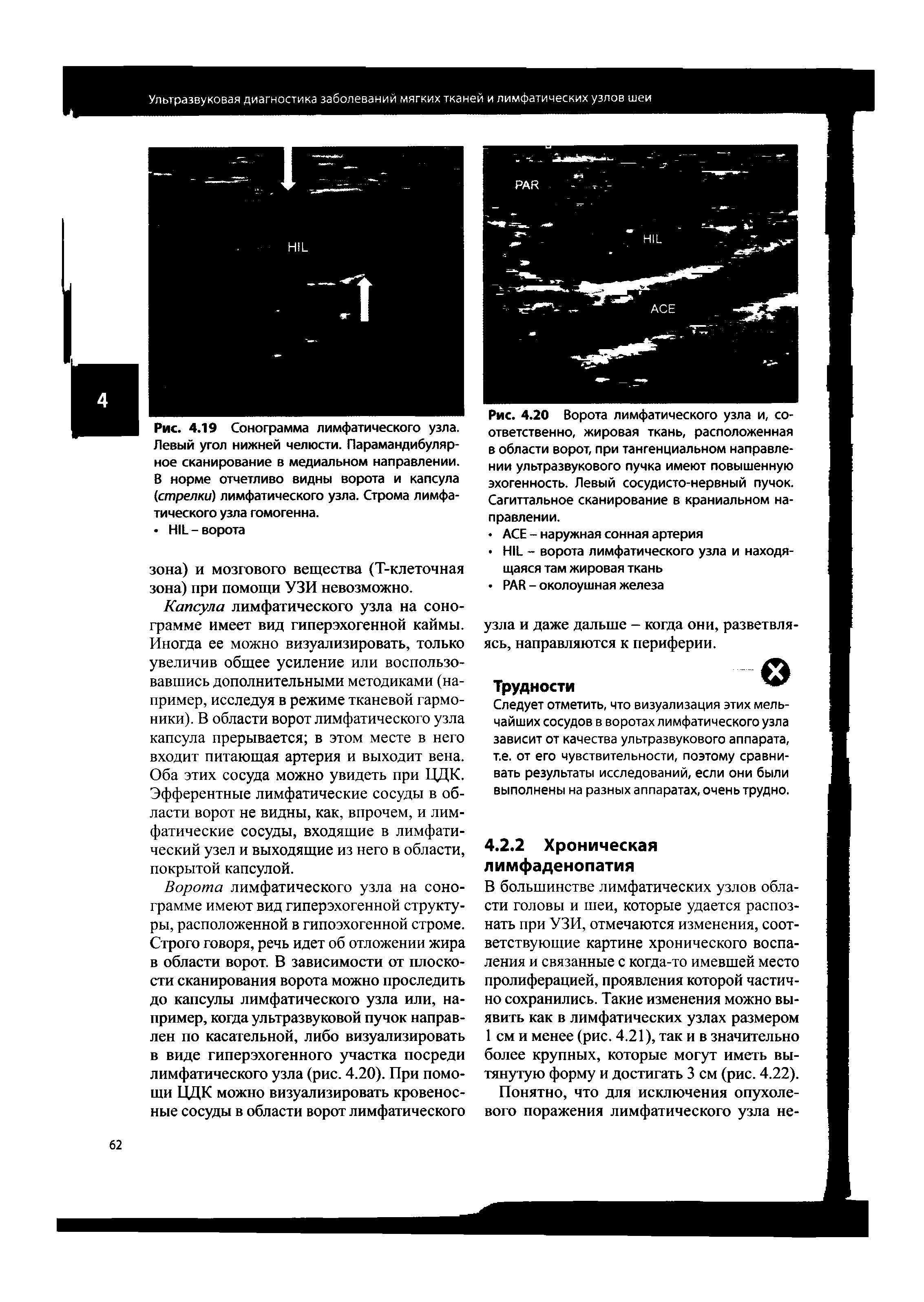Рис. 4.20 Ворота лимфатического узла и, соответственно, жировая ткань, расположенная в области ворот, при тангенциальном направлении ультразвукового пучка имеют повышенную эхогенность. Левый сосудисто-нервный пучок. Сагиттальное сканирование в краниальном на-...