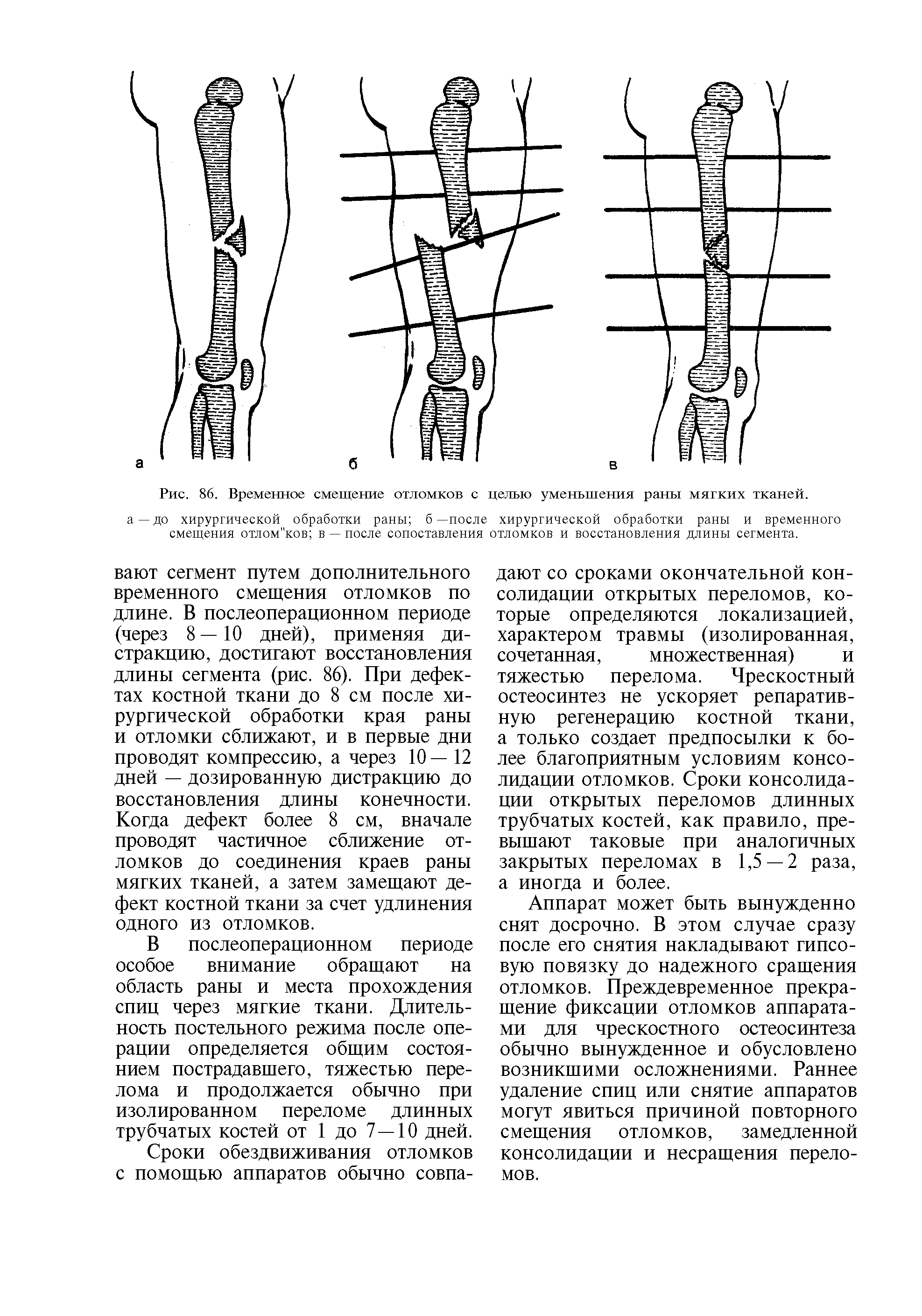 Рис. 86. Временное смещение отломков с целью уменьшения раны мягких тканей.